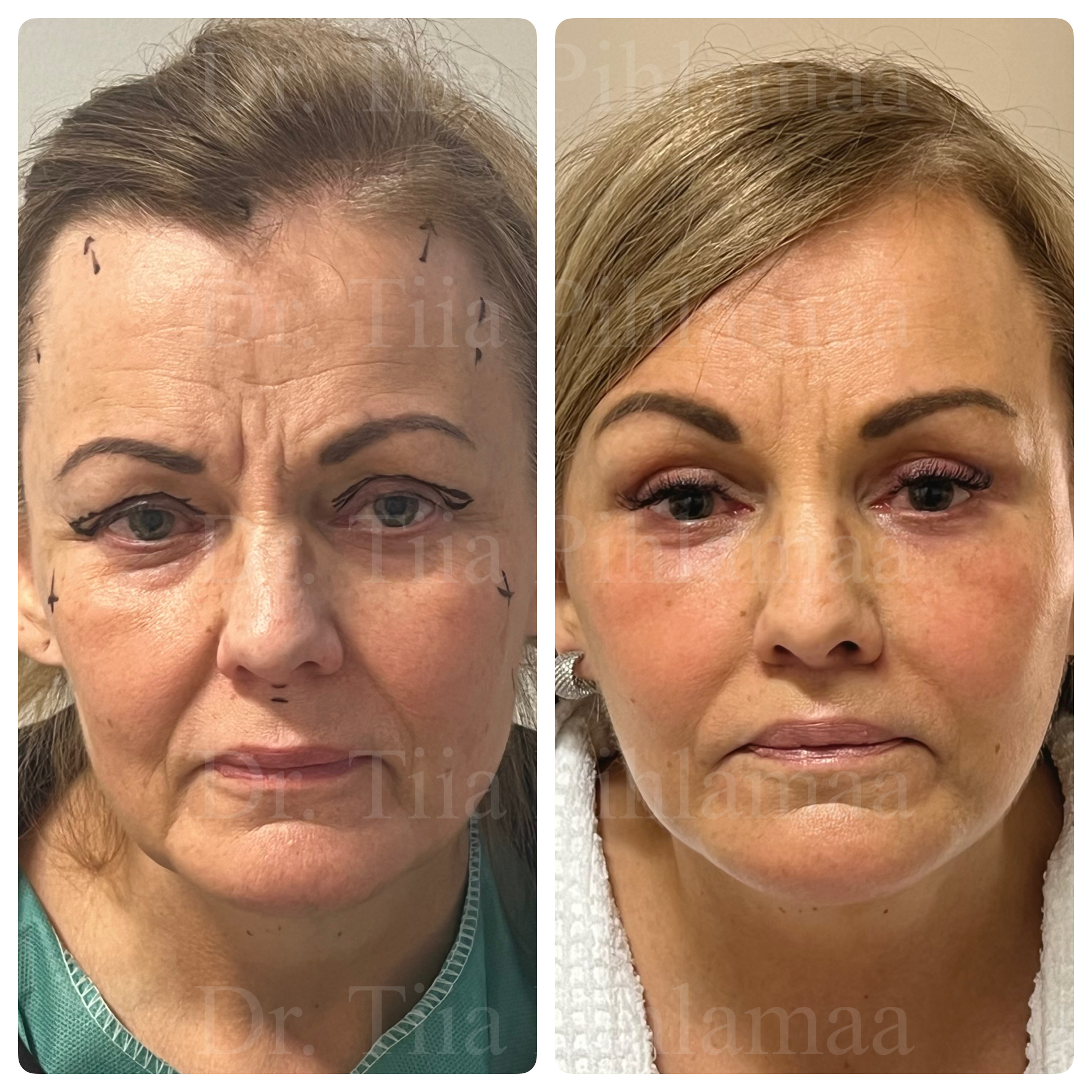 Front-view before and after photographs of a full facelift; before surgery on the left and two months after surgery on the right. The patient has given consent for publication.