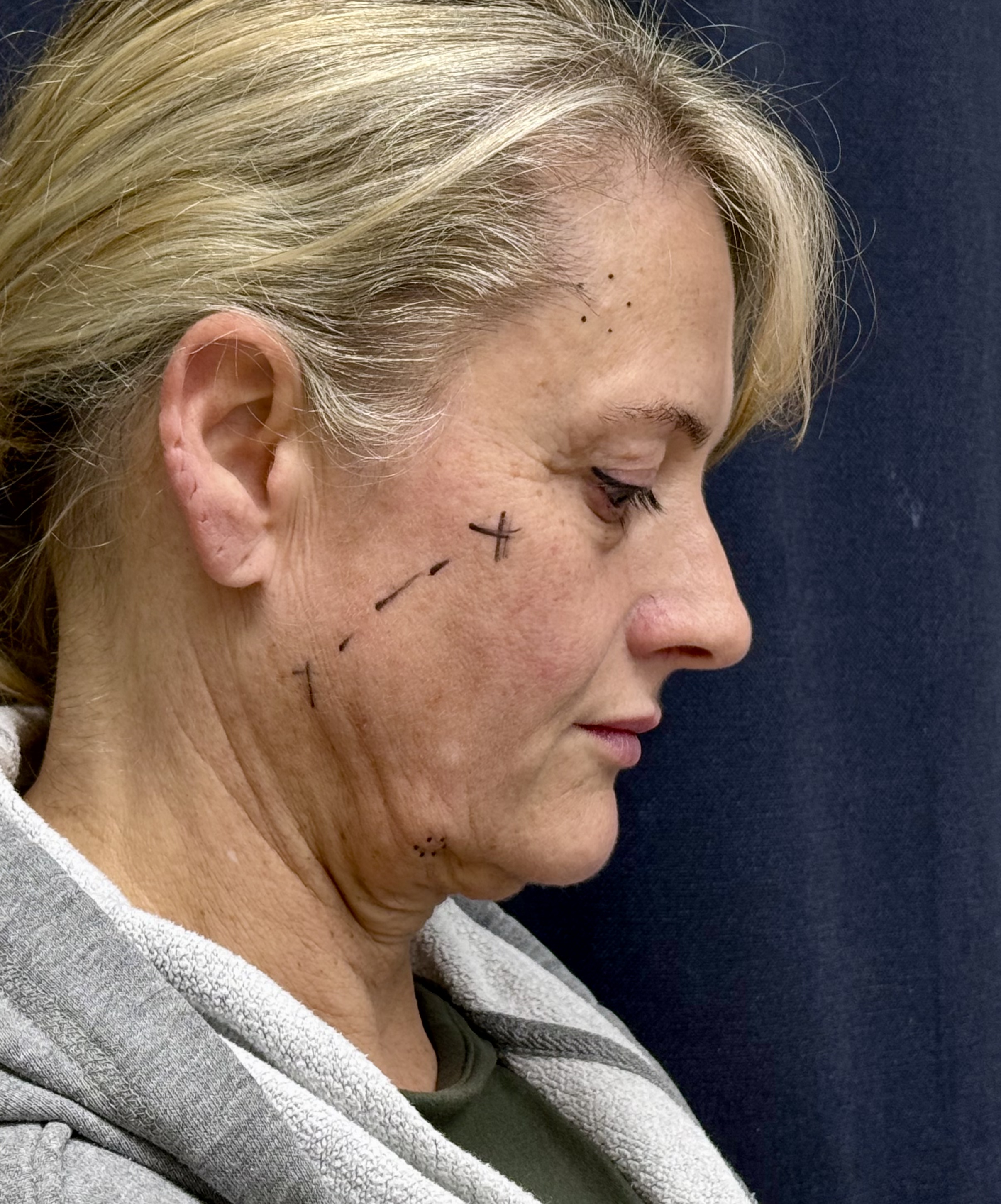 Patient's facial side profile before surgery, showing the hairline, ear and neck