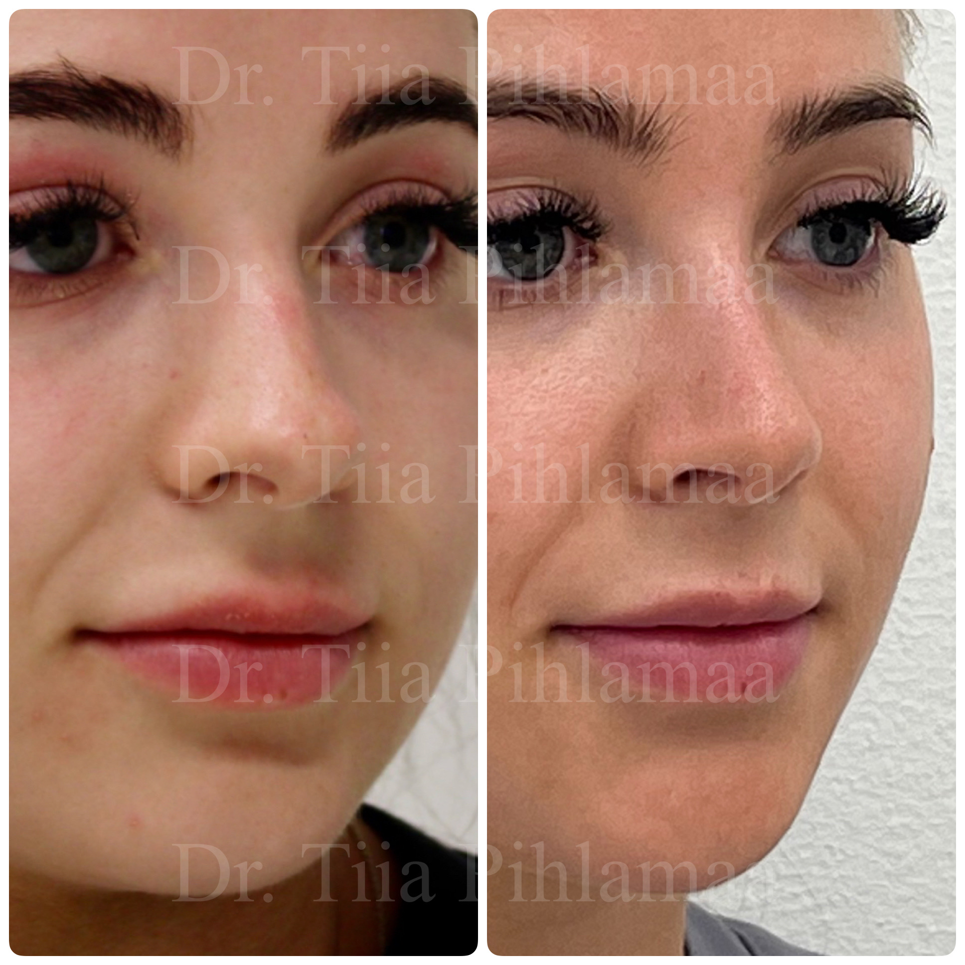 Before and after photographs of a nasal procedure in a three-quarter view combined in a single image; the left photo shows the appearance before the procedure and the right one after it. The patient has given consent for publication.