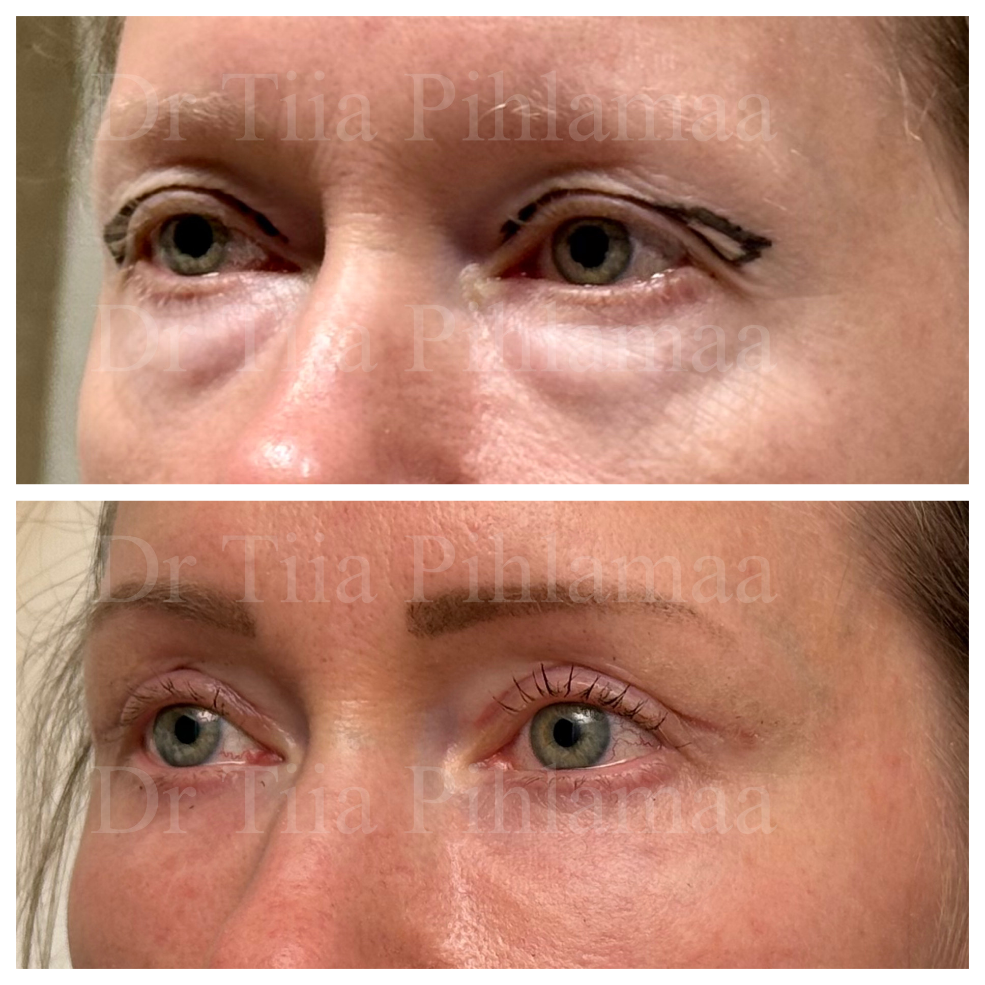 Left three-quarter-view before and after photographs of upper and lower eyelid treatment; before surgery above and six weeks after surgery below. The patient has given consent for publication.