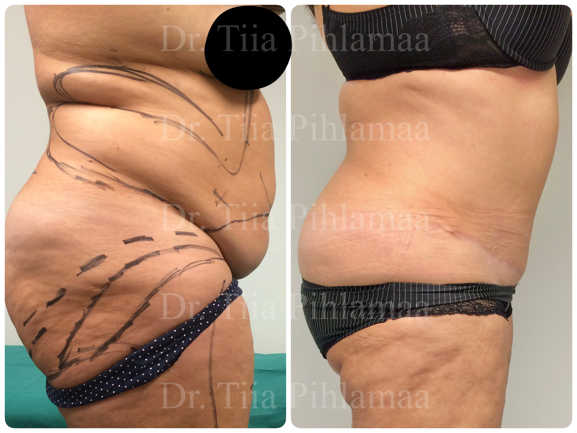 Before and after photographs of abdominoplasty in side profile combined in a single image; the left photo shows the appearance before surgery and the right one two months after it. The patient has given consent for publication.