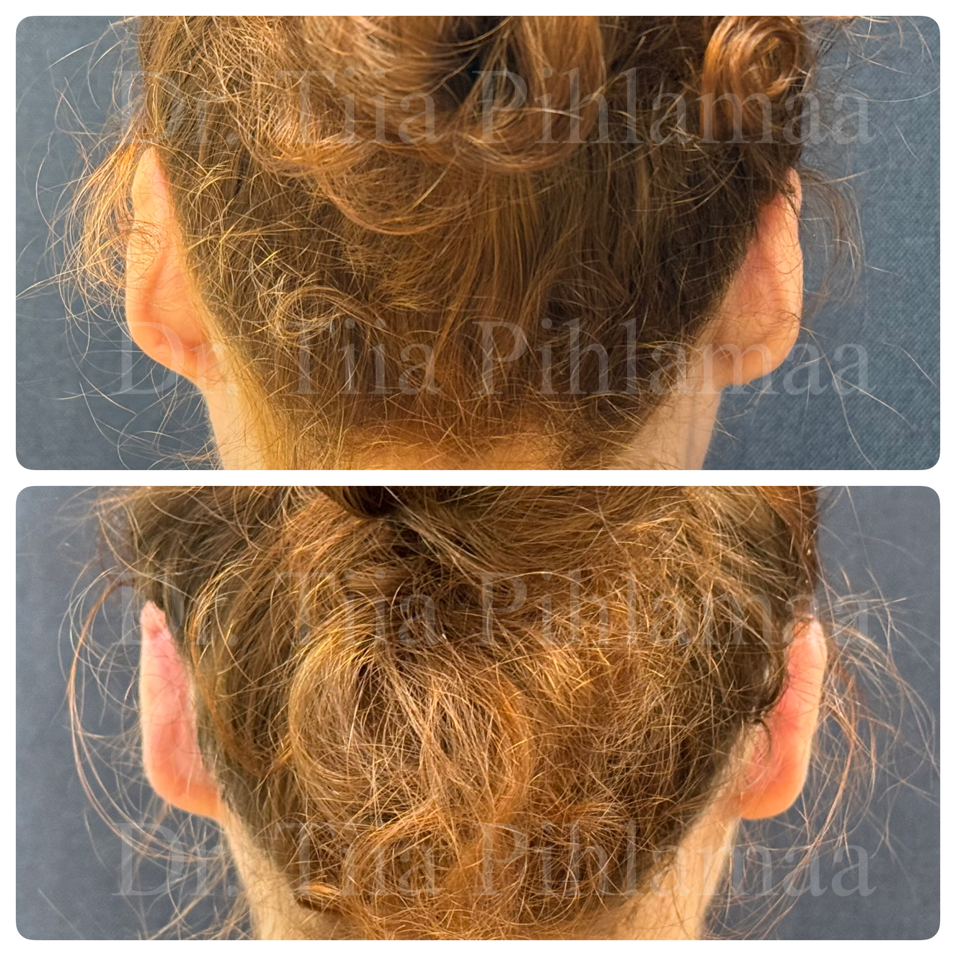 Before and after photographs of cryptotia correction surgery from behind the head showing both ears, stacked vertically; the upper photo shows the appearance before the procedure and the lower one two months after it. The patient has given consent for publication.