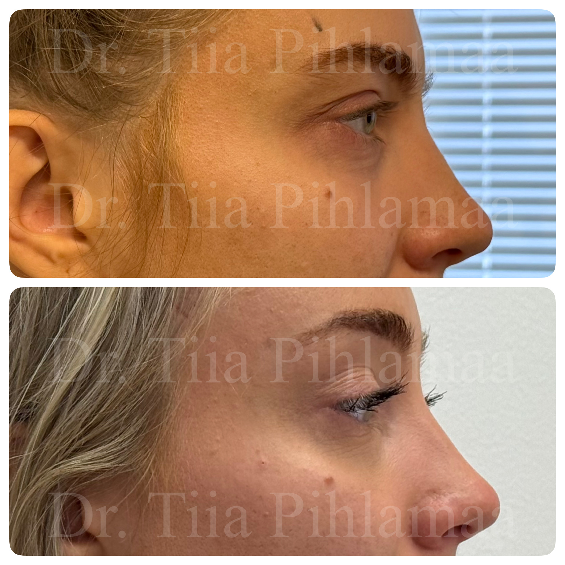 Before and after photographs of a procedure on the forehead and brow area in side profile from the other side combined in a single image; the upper photo shows the appearance before the procedure and the lower one after it. The patient has given consent for publication.