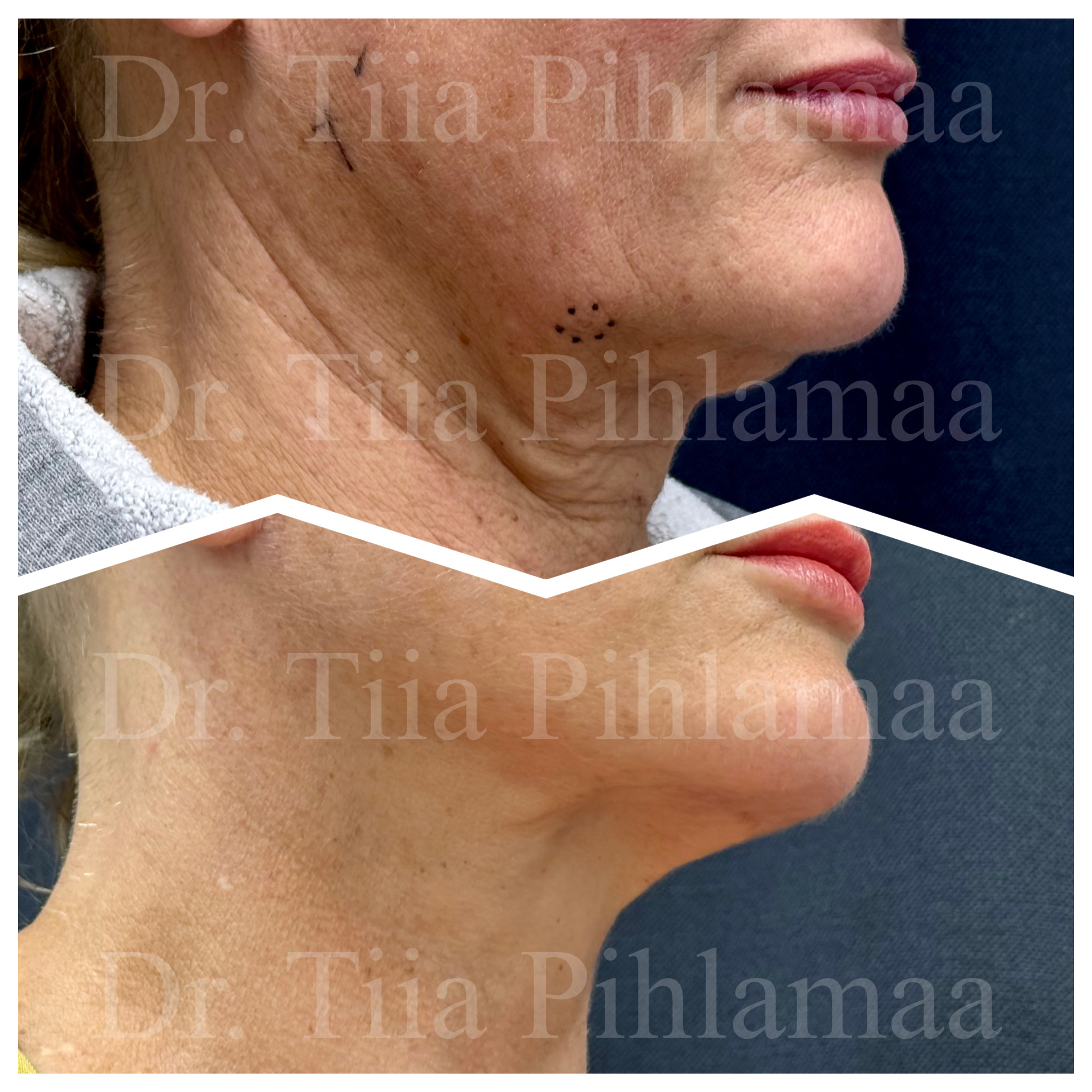 Before and after close-up photographs of a neck lift in side profile combined in a single image; the upper photo shows the appearance before the procedure and the lower one after it. The patient has given consent for publication.
