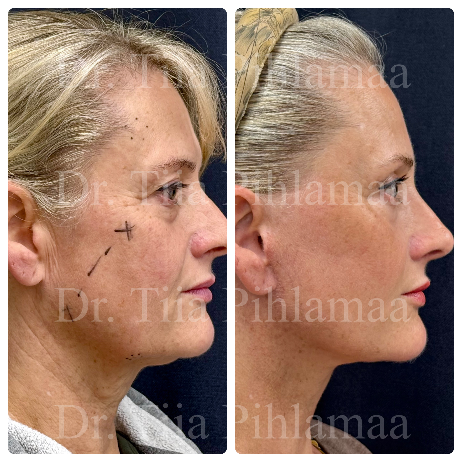 Before and after photographs of a face and neck lift in a three-quarter view combined in a single image; the left photo shows the appearance before the procedure and the right one after it. The patient has given consent for publication.