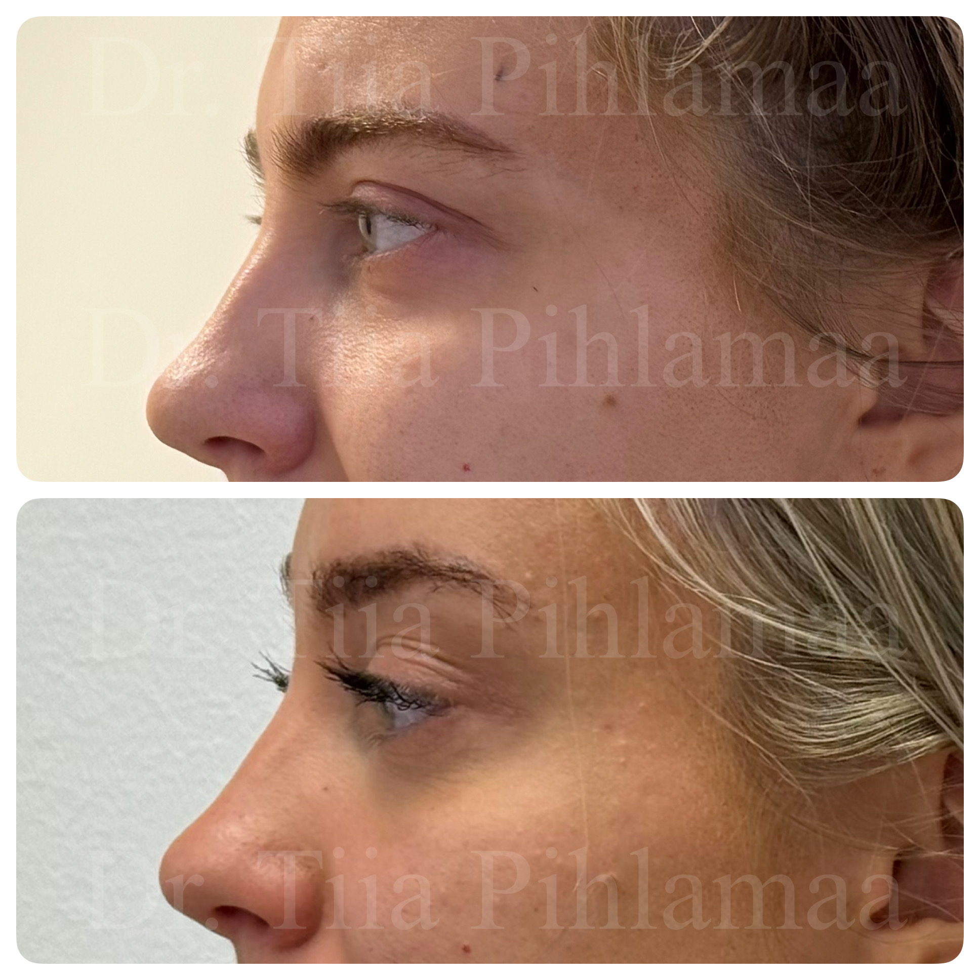 Before and after photographs of a procedure on the forehead and brow area in side profile combined in a single image; the upper photo shows the appearance before the procedure and the lower one after it. The patient has given consent for publication.