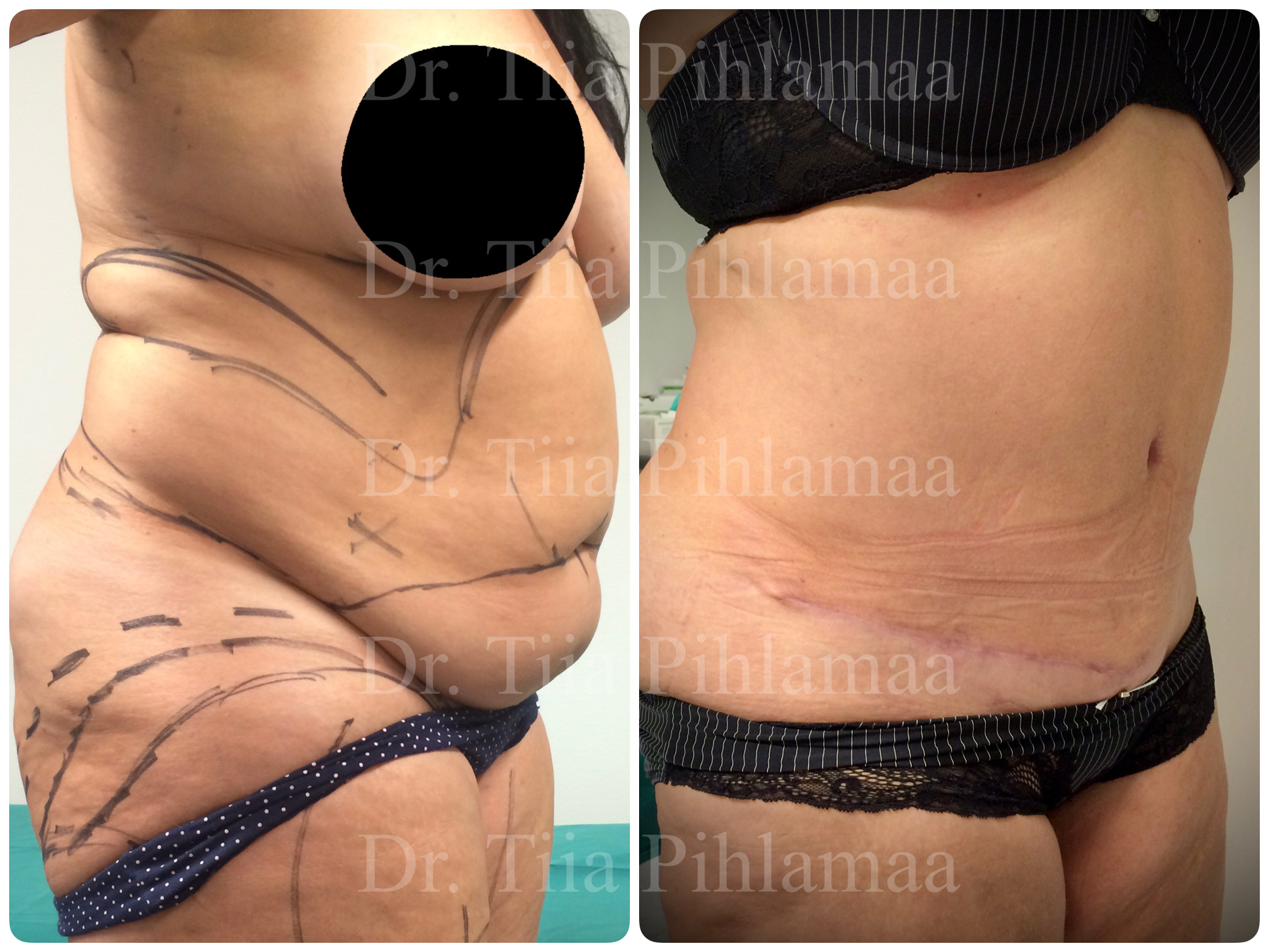 Before and after photographs of abdominoplasty from an oblique angle combined in a single image; the left photo shows the appearance before surgery and the right one two months after it. The patient has given consent for publication.