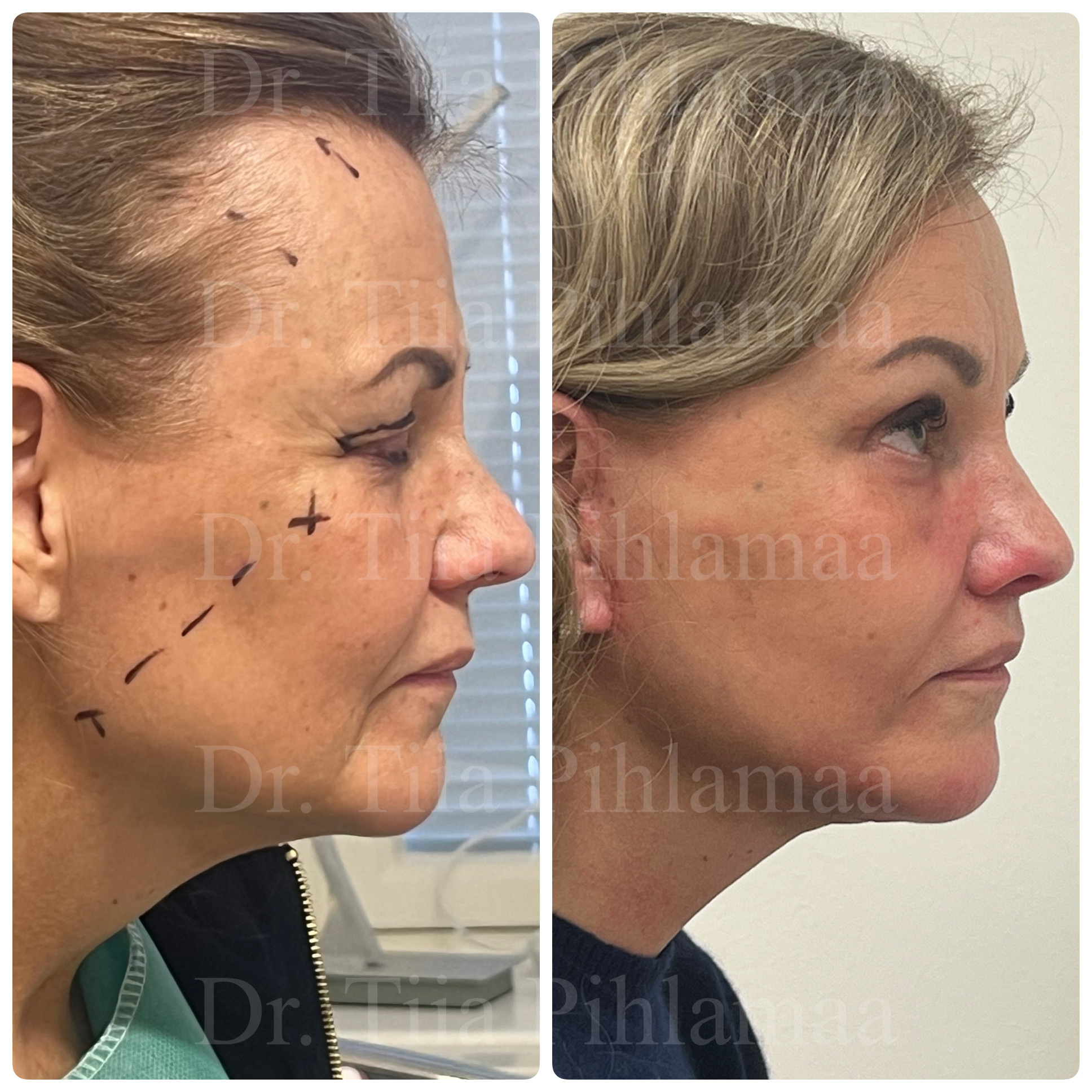 Profile-view before and after photographs of a full facelift; before surgery on the left and two months after surgery on the right. The patient has given consent for publication.