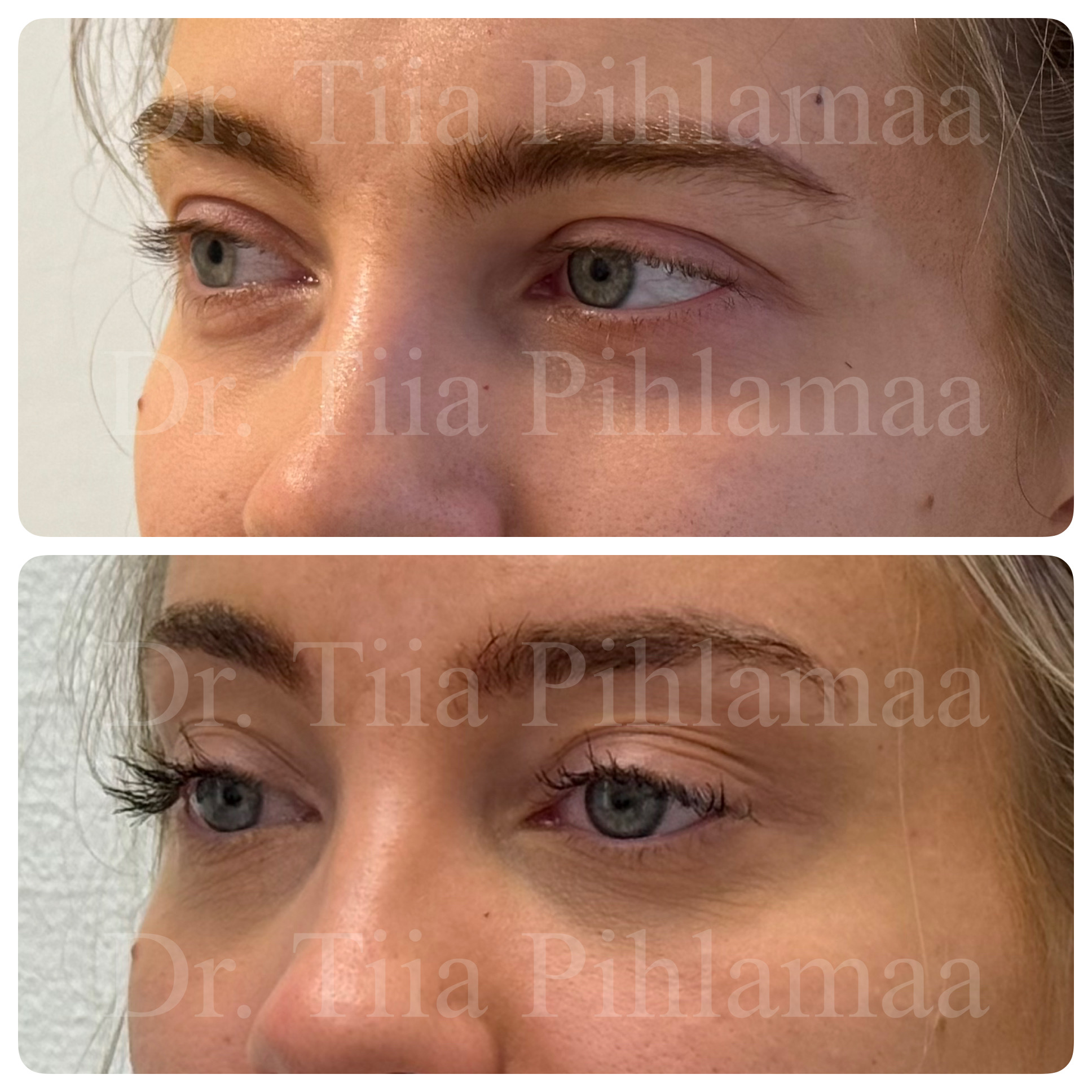 Before and after photographs of a procedure on the forehead and brow area around the eyes combined in a single image; the upper photo shows the appearance before the procedure and the lower one after it. The patient has given consent for publication.