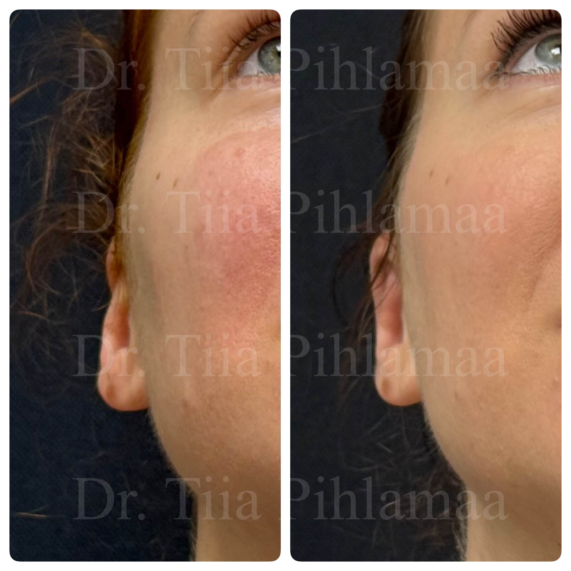 Before and after photographs of cryptotia correction surgery in a close-up of the cheek and ear area in a three-quarter view combined in a single image; the left photo shows the appearance before the procedure and the right one two months after it. The patient has given consent for publication.