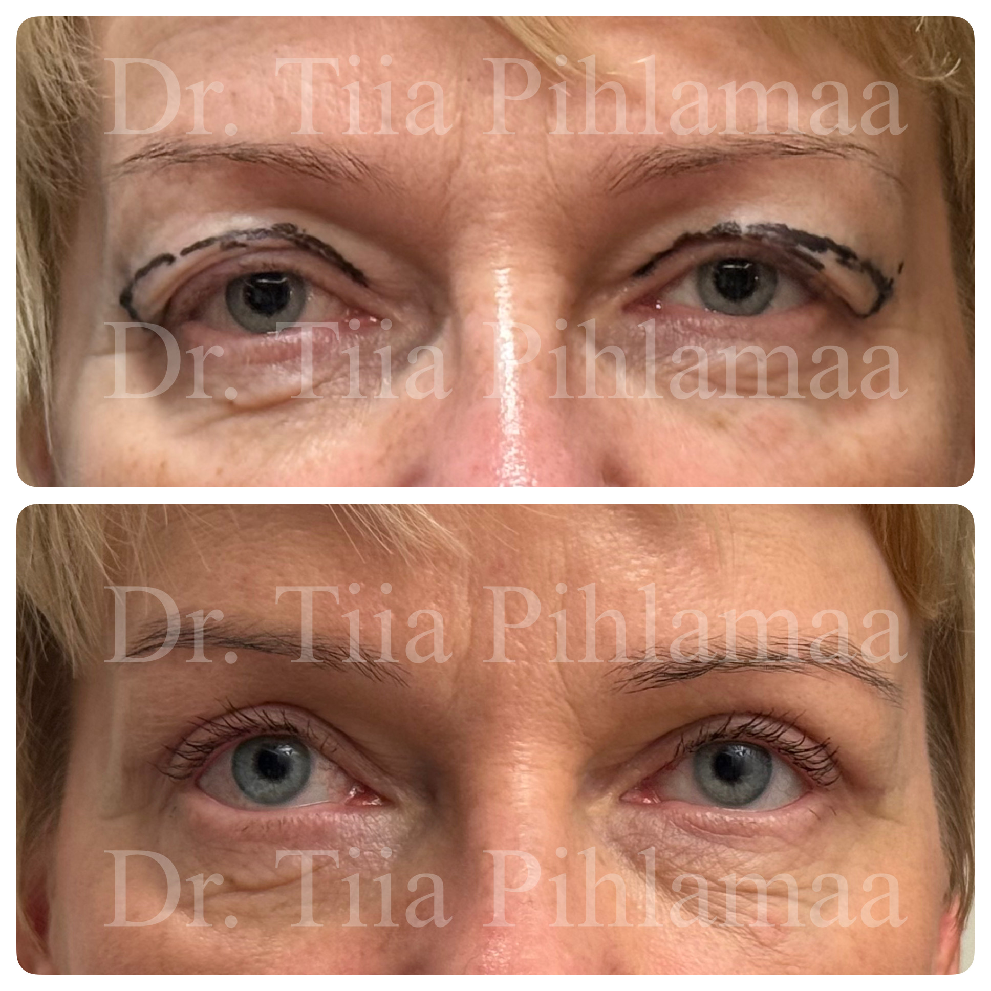 Before and after photographs of upper eyelid surgery combined in a single image; the upper photo shows the appearance before the procedure and the lower one after it. The patient has given consent for publication.