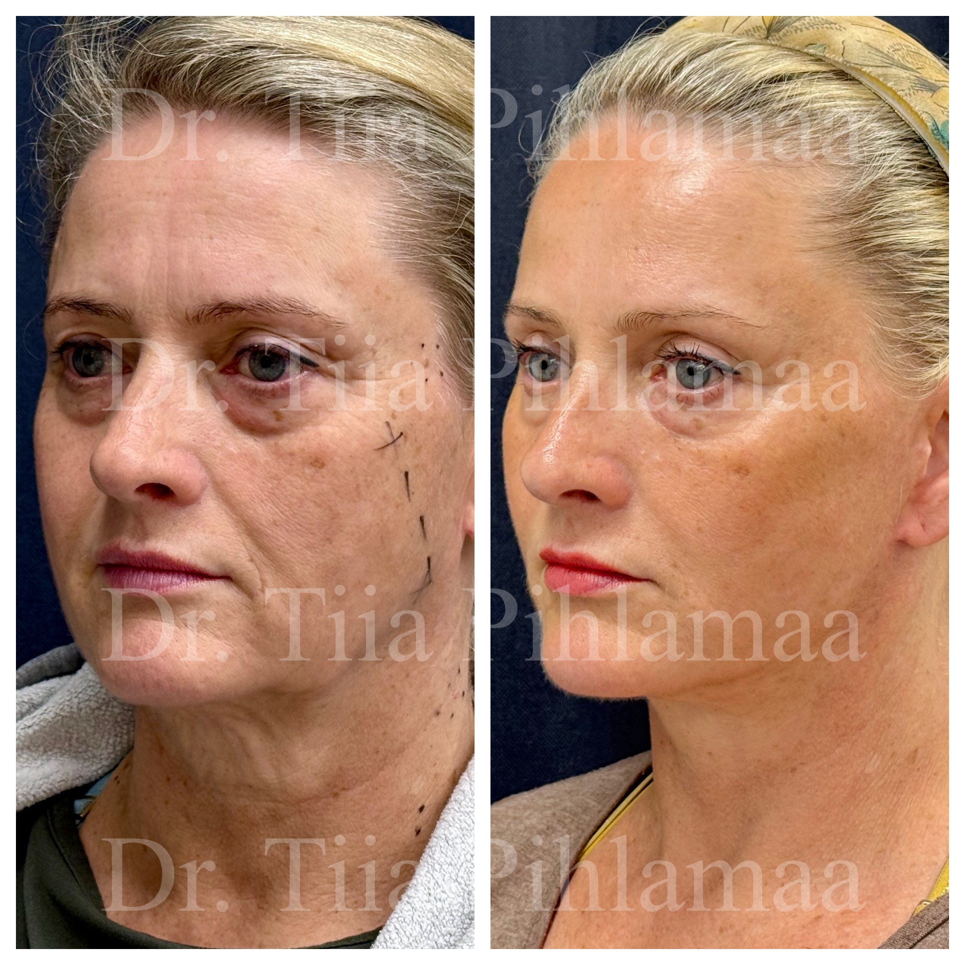 Before and after photographs of a face and neck lift in a three-quarter view from the other side combined in a single image; the left photo shows the appearance before the procedure and the right one after it. The patient has given consent for publication.