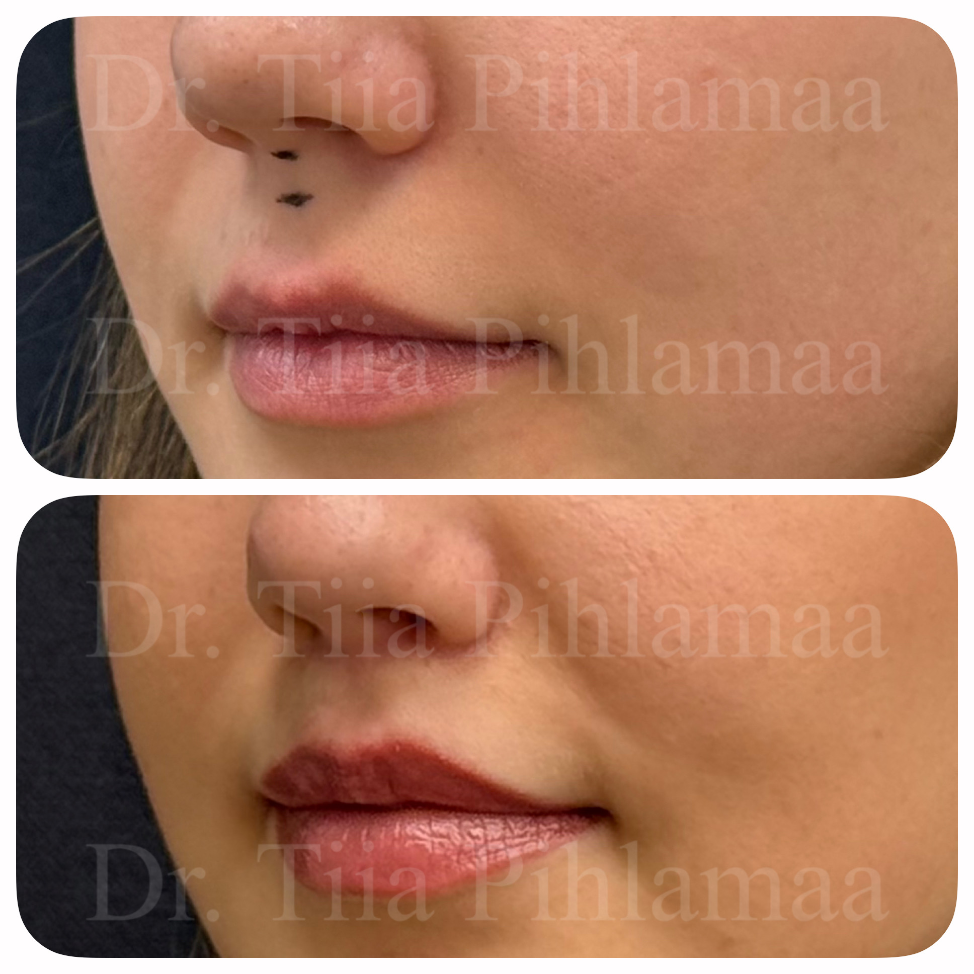Before and after photographs of a procedure on the lip area in three-quarter view from the other side combined in a single image; the upper photo shows the appearance before the procedure and the lower one after it. The patient has given consent for publication.