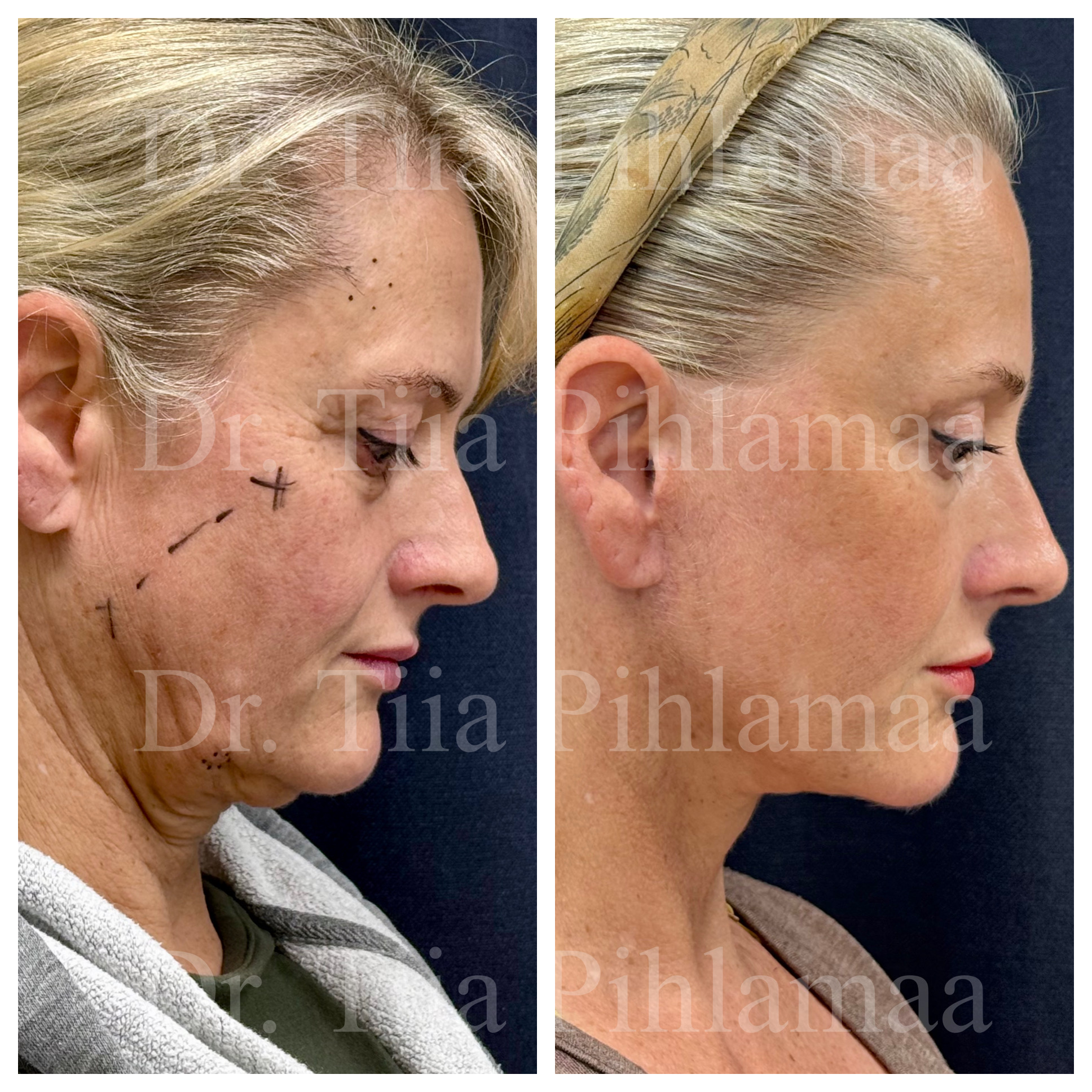 Before and after photographs of a face and neck lift in side profile looking downward combined in a single image; the left photo shows the appearance before the procedure and the right one after it. The patient has given consent for publication.