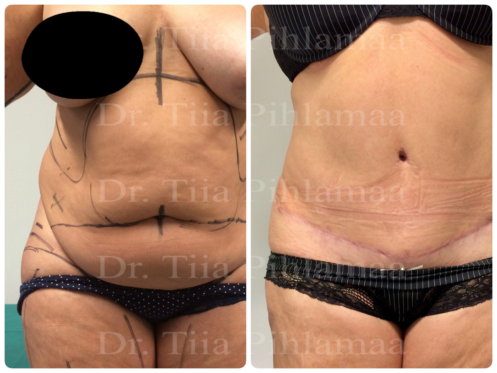 Before and after photographs of abdominoplasty from the front combined in a single image; the left photo shows the appearance before surgery and the right one two months after it. The patient has given consent for publication.