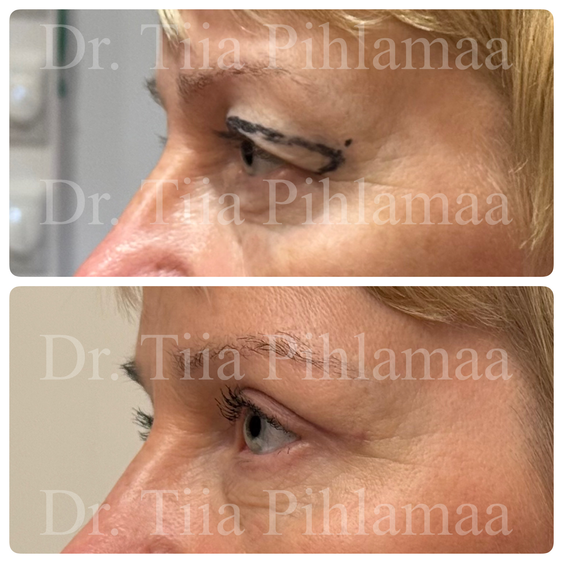 Before and after close-up photographs of upper eyelid surgery of the left eye in side profile, stacked vertically; surgical markings are visible in the before photo. The patient has given consent for publication.