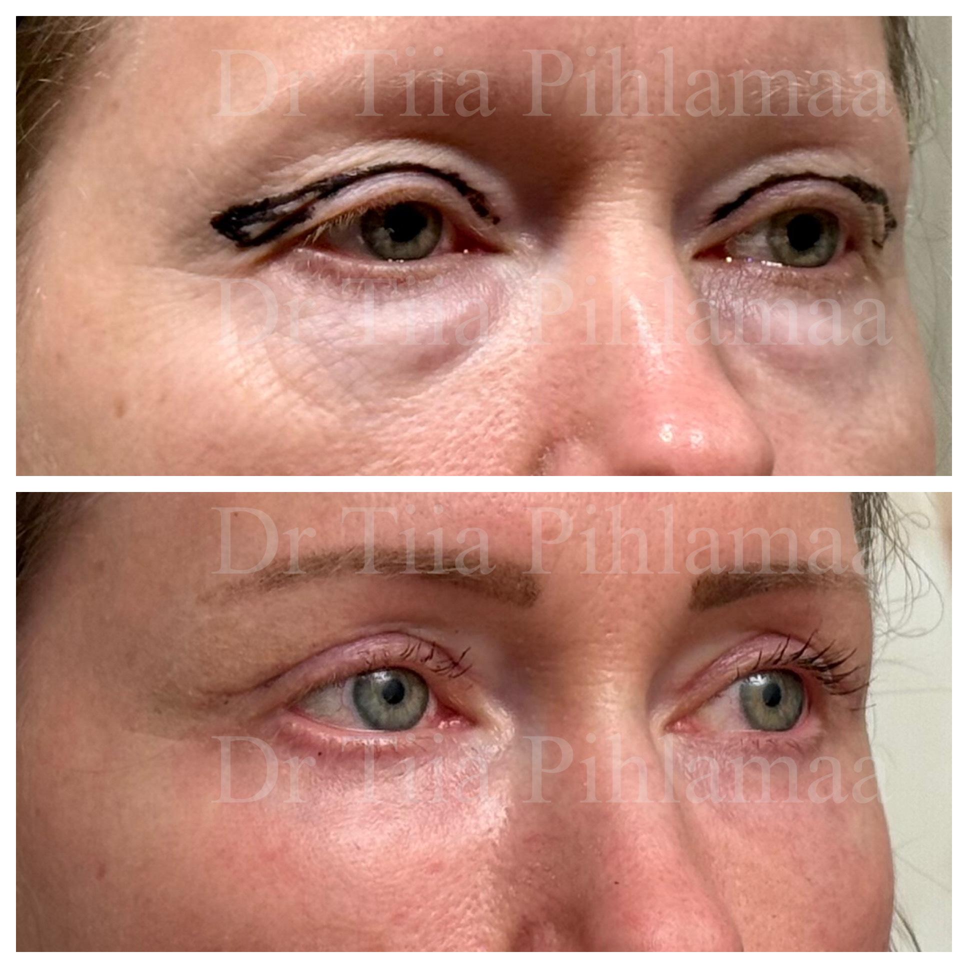 Right three-quarter-view before and after photographs of upper and lower eyelid treatment; before surgery above and six weeks after surgery below. The patient has given consent for publication.