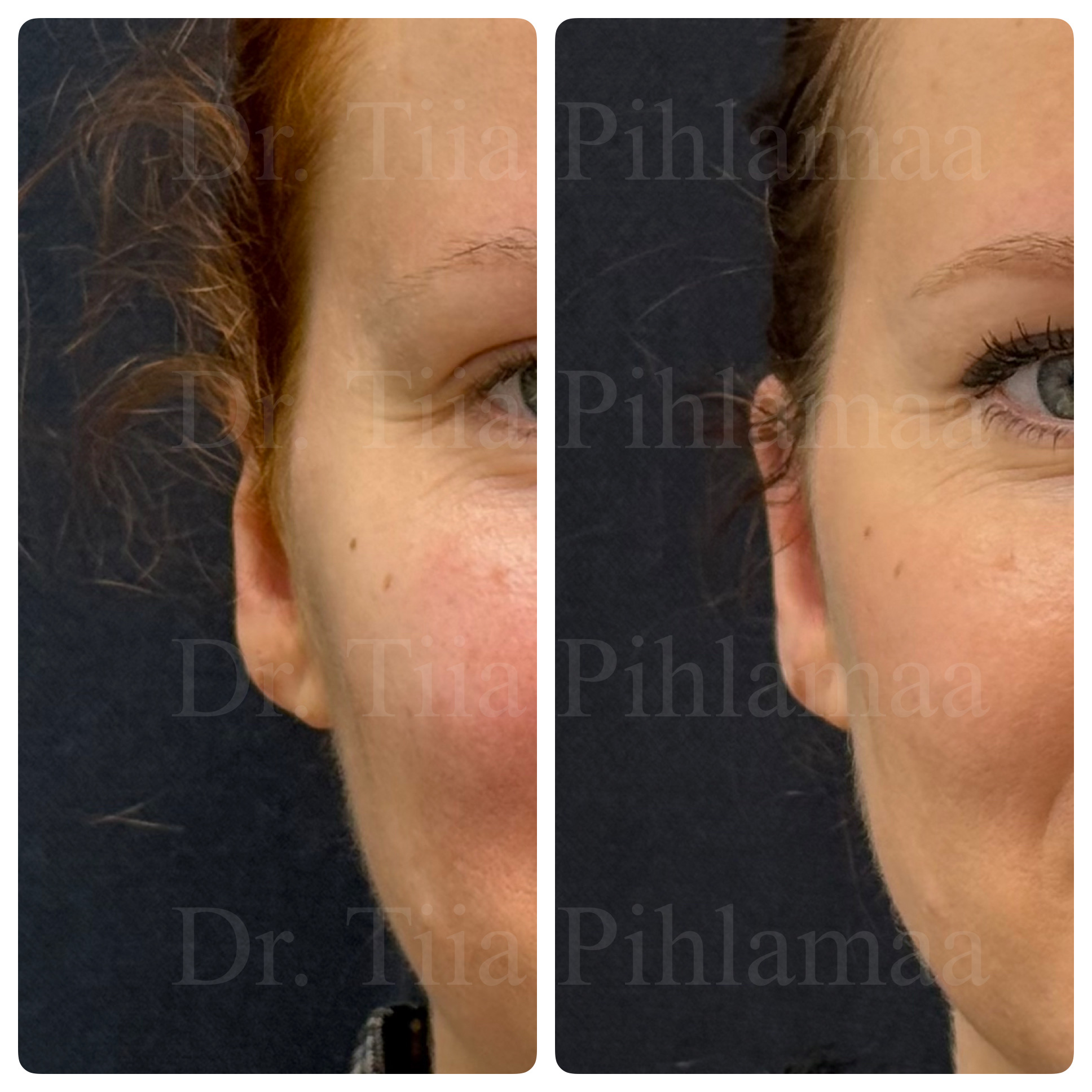 Before and after photographs of cryptotia correction surgery in a close-up of the ear and temple area combined in a single image; the left photo shows the appearance before the procedure and the right one two months after it. The patient has given consent for publication.