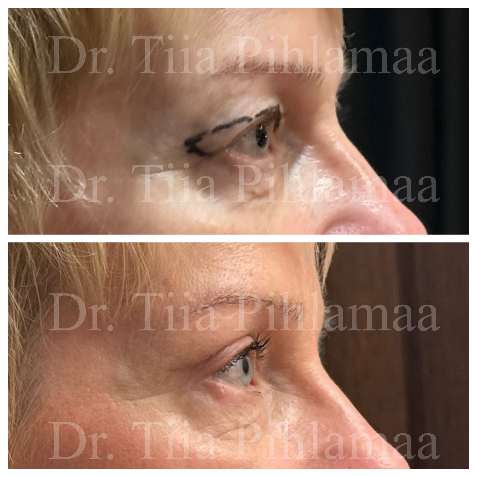 Before and after photographs of upper eyelid surgery of the right eye in side profile, stacked vertically; surgical markings are visible in the before photo. The patient has given consent for publication.