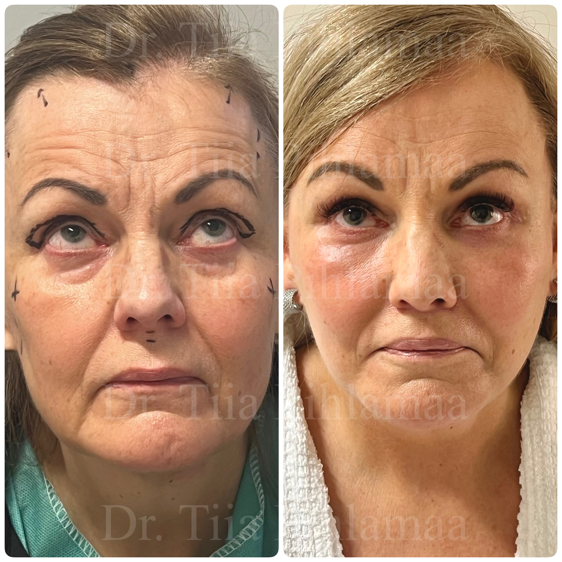 Upward-gaze before and after photographs of a full facelift; before surgery on the left and two months after surgery on the right. The patient has given consent for publication.