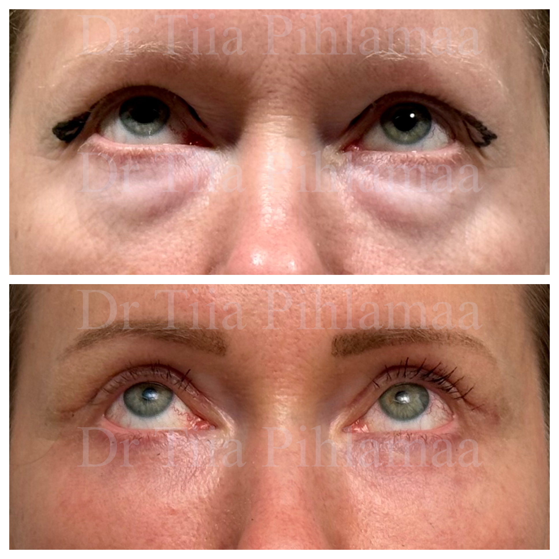 Upward-gaze before and after photographs of upper and lower eyelid treatment; before surgery above and six weeks after surgery below. The patient has given consent for publication.