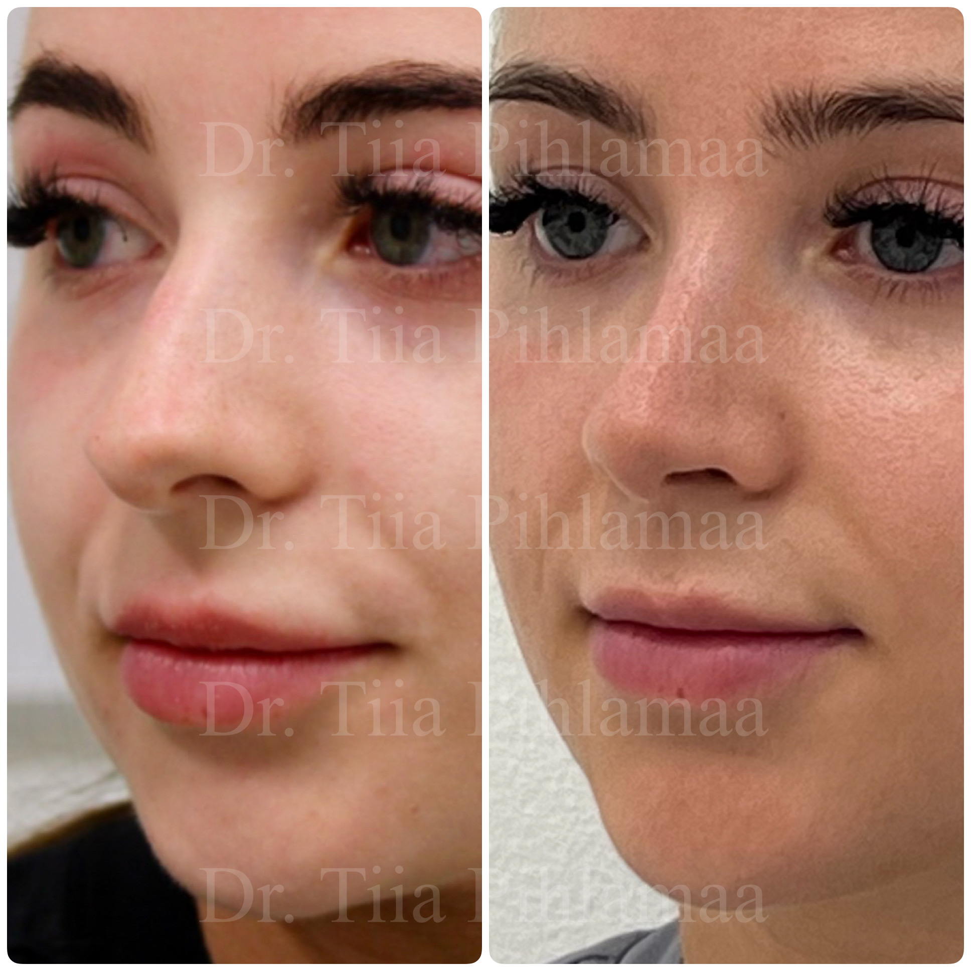 Before and after photographs of a nasal procedure in a three-quarter view from the other side combined in a single image; the left photo shows the appearance before the procedure and the right one after it. The patient has given consent for publication.