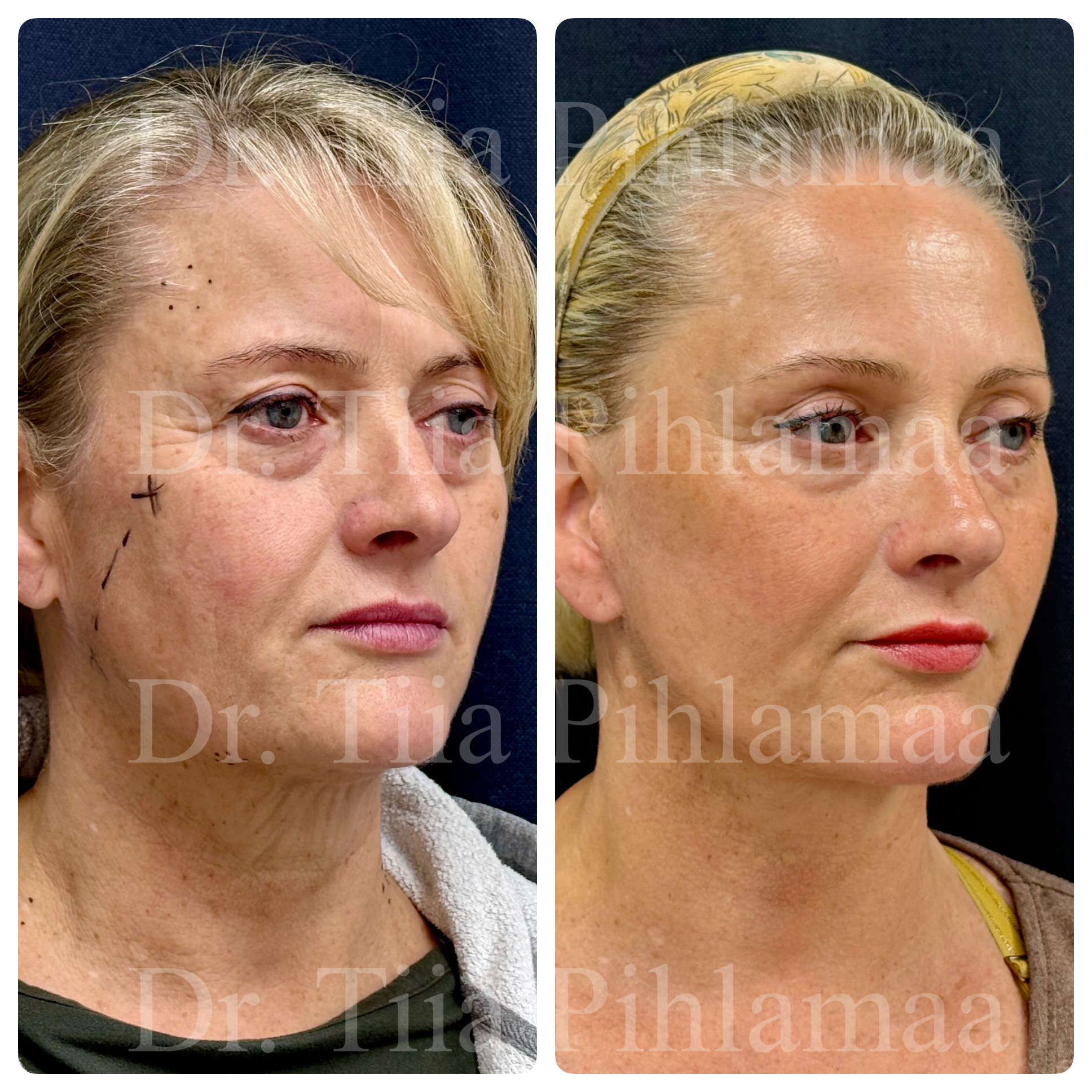 Before and after photographs of a face and neck lift from the front combined in a single image; the left photo shows the appearance before the procedure and the right one after it. The patient has given consent for publication.