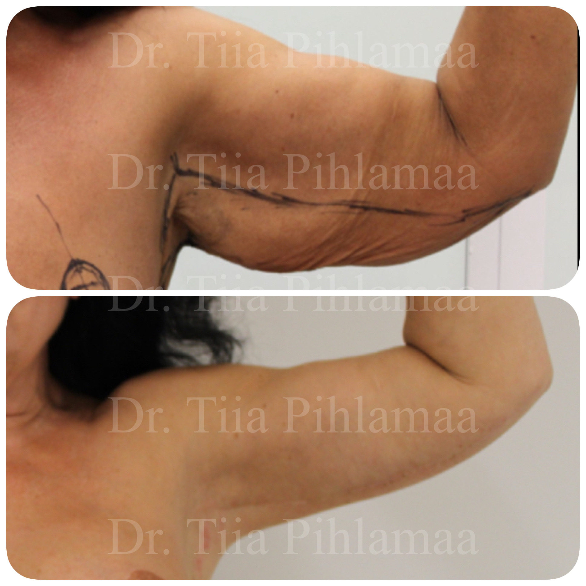 Before and after photographs of a procedure on the upper arm area combined in a single image; the upper photo shows the appearance before the procedure with surgical markings and the lower one after it. The patient has given consent for publication.
