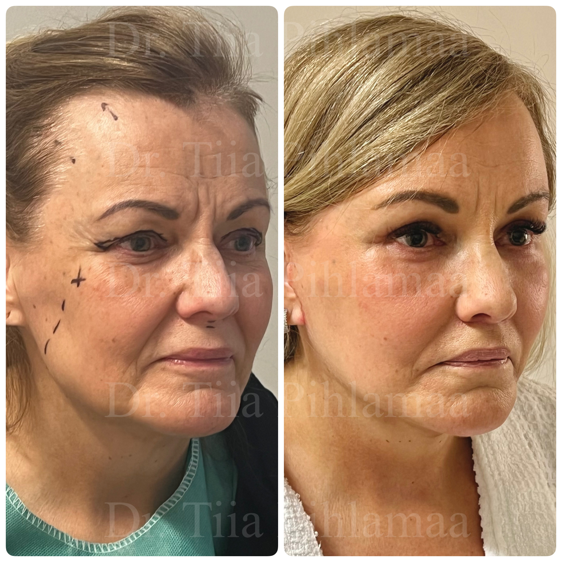 Right three-quarter-view before and after photographs of a full facelift; before surgery on the left and two months after surgery on the right. The patient has given consent for publication.