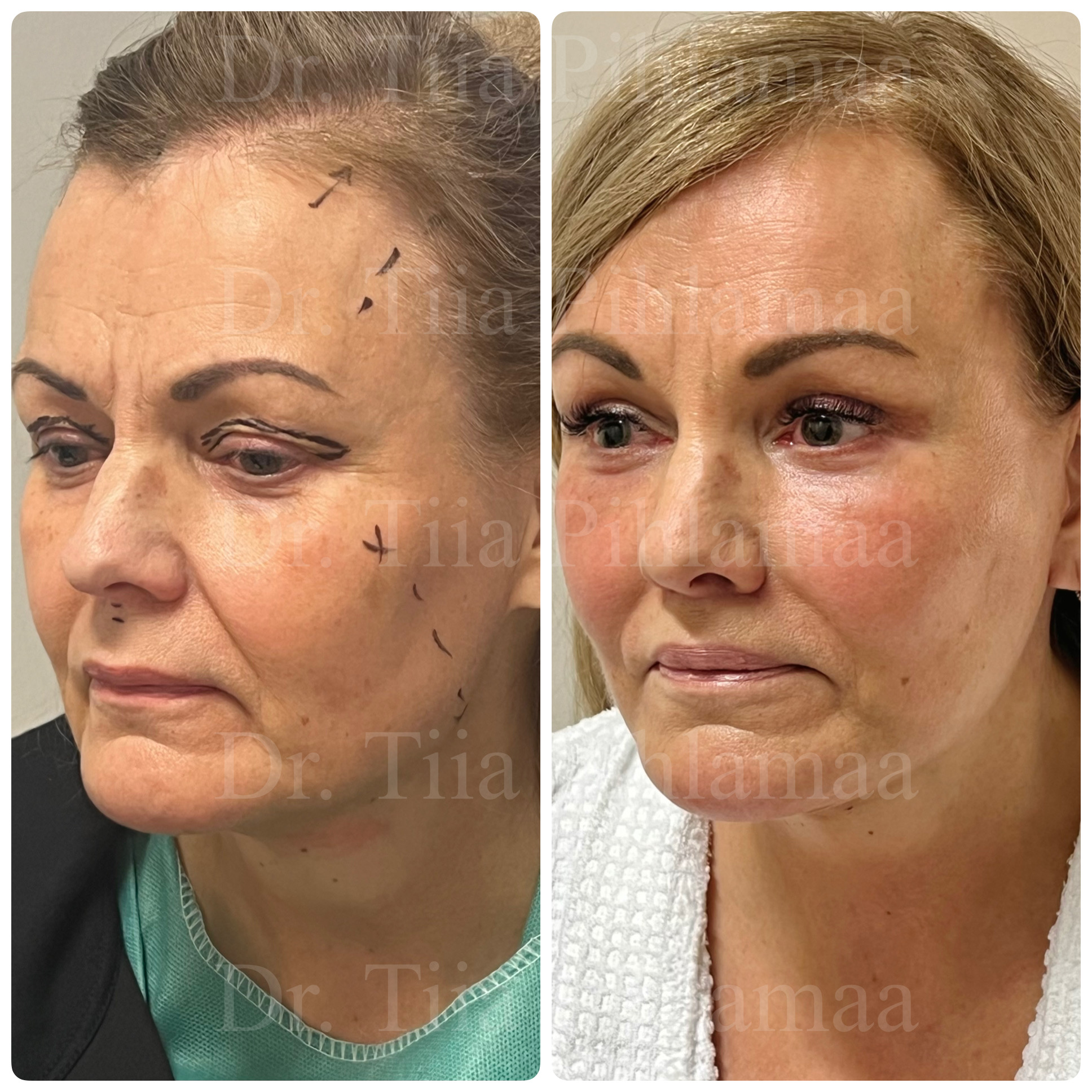 Left three-quarter-view before and after photographs of a full facelift; before surgery on the left and two months after surgery on the right. The patient has given consent for publication.