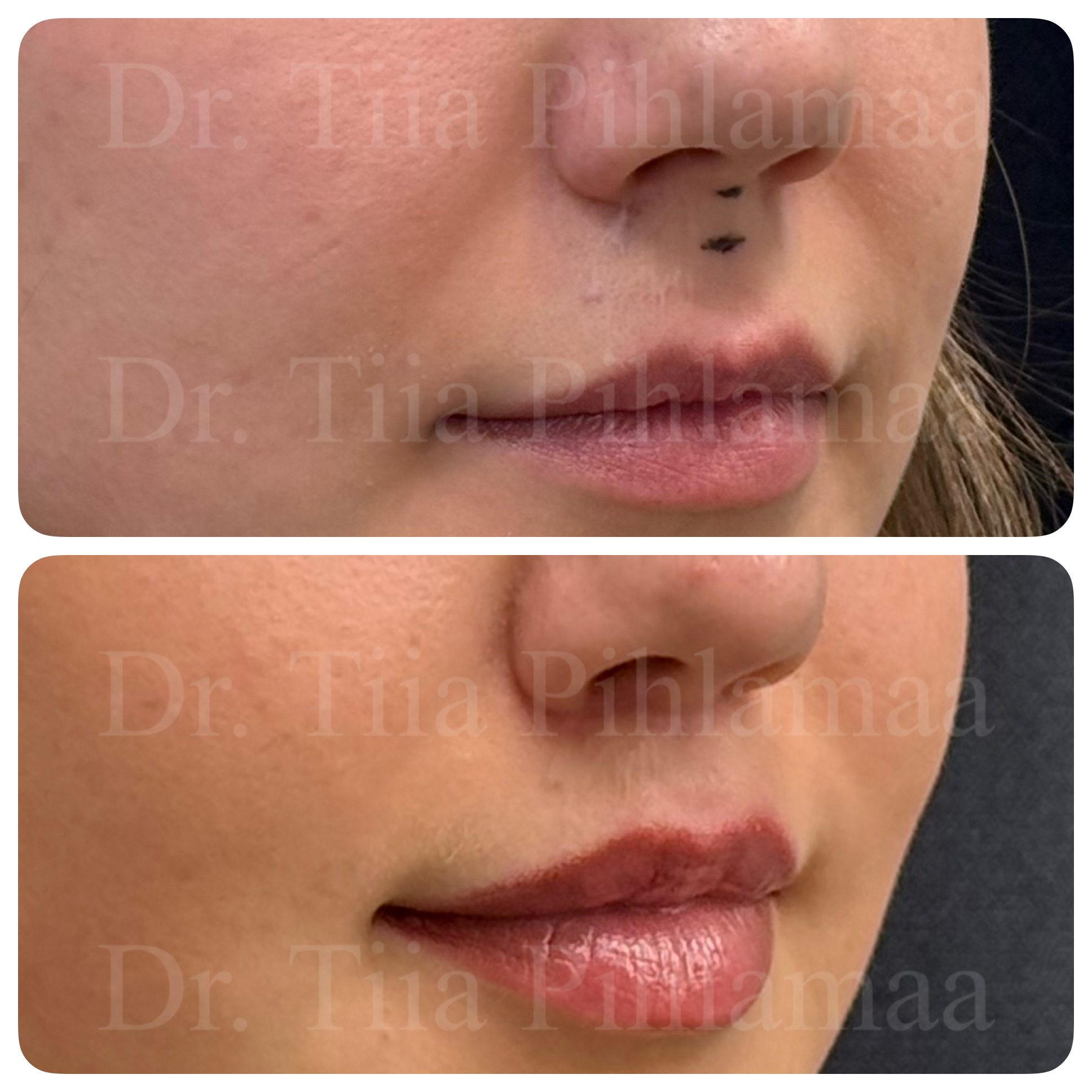 Before and after photographs of a procedure on the lip area in frontal view combined in a single image; the upper photo shows the appearance before the procedure and the lower one after it. The patient has given consent for publication.