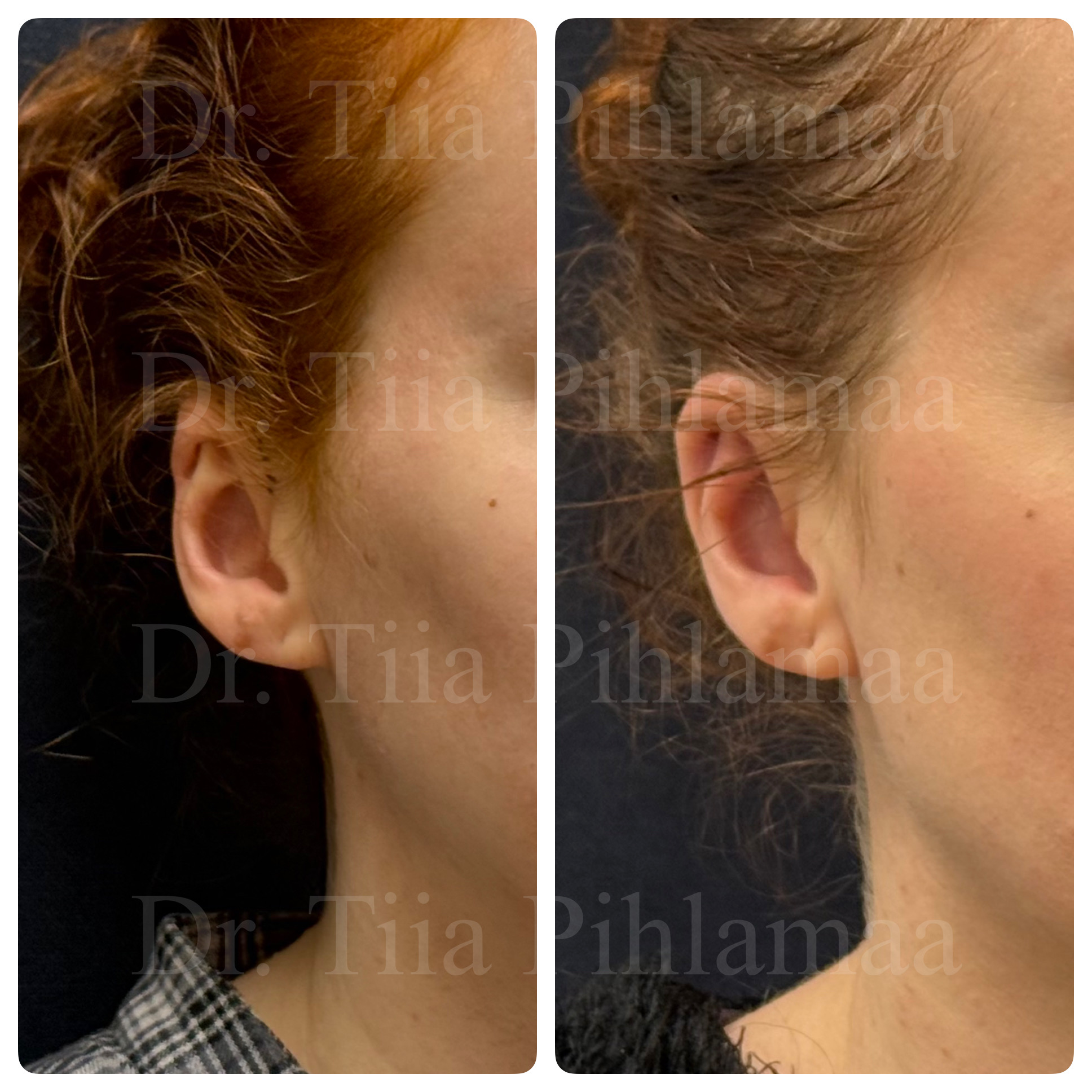 Before and after photographs of a procedure on the ear area in side profile combined in a single image; the left photo shows the appearance before the procedure and the right one after it. The patient has given consent for publication.
