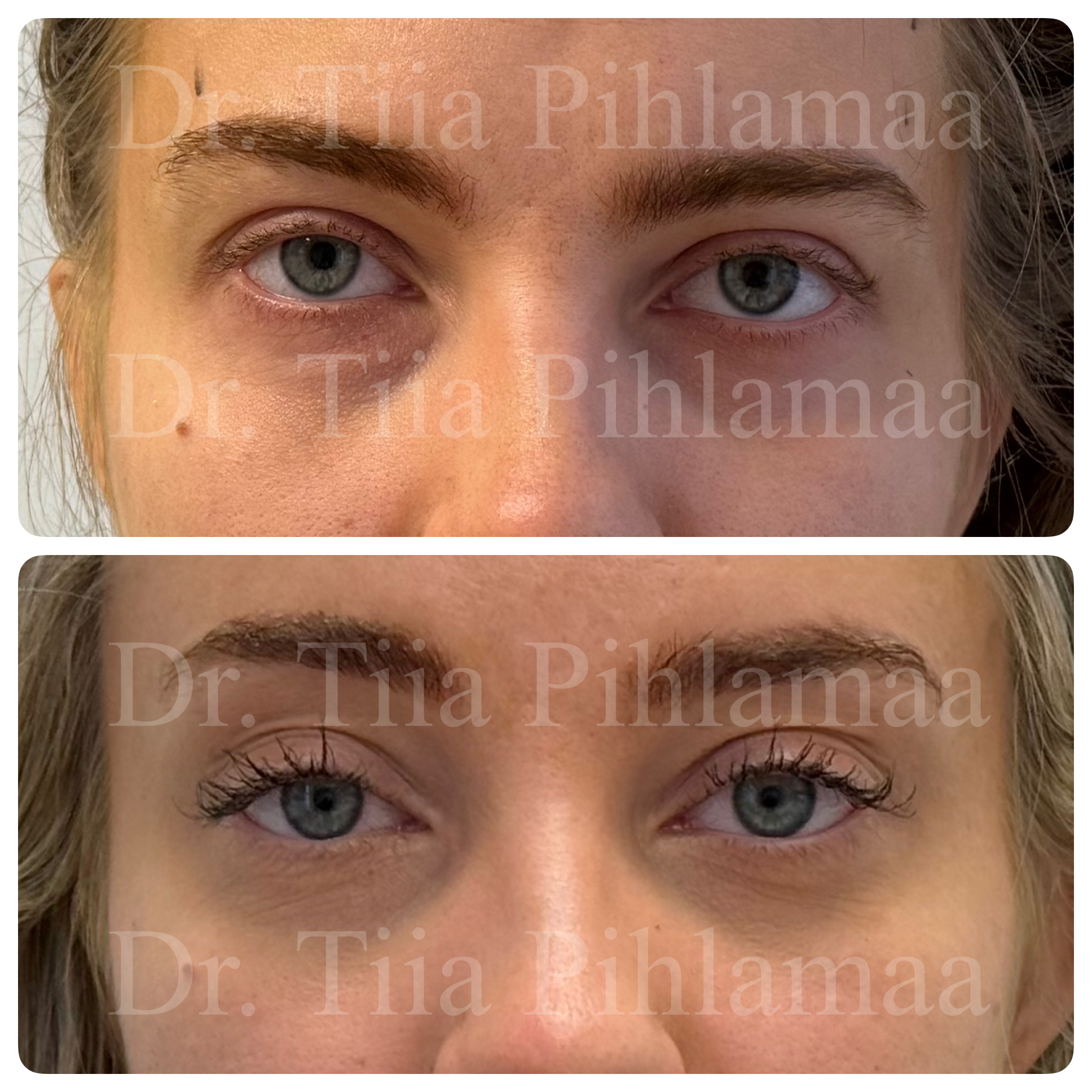 Before and after photographs of a procedure on the forehead and brow area from the front combined in a single image; the upper photo shows the appearance before the procedure and the lower one after it. The patient has given consent for publication.