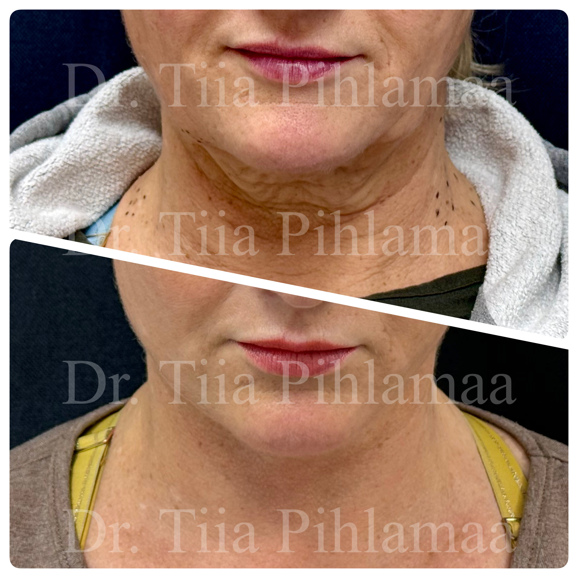 Before and after close-up photographs of a neck lift from the front combined in a single image; the upper photo shows the appearance before the procedure and the lower one after it. The patient has given consent for publication.
