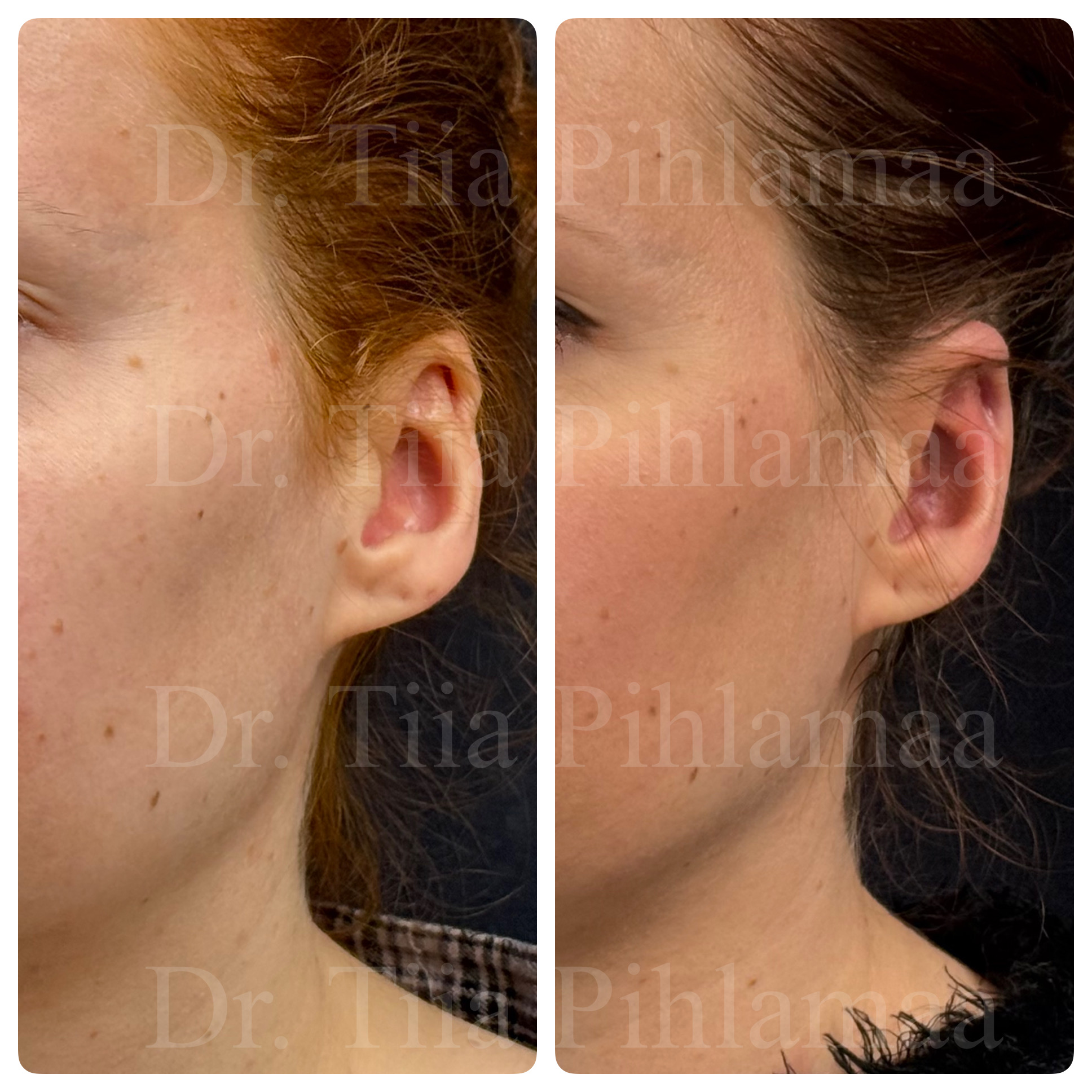 Before and after photographs of cryptotia correction surgery in side profile from the other side combined in a single image; the left photo shows the appearance before the procedure and the right one two months after it. The patient has given consent for publication.