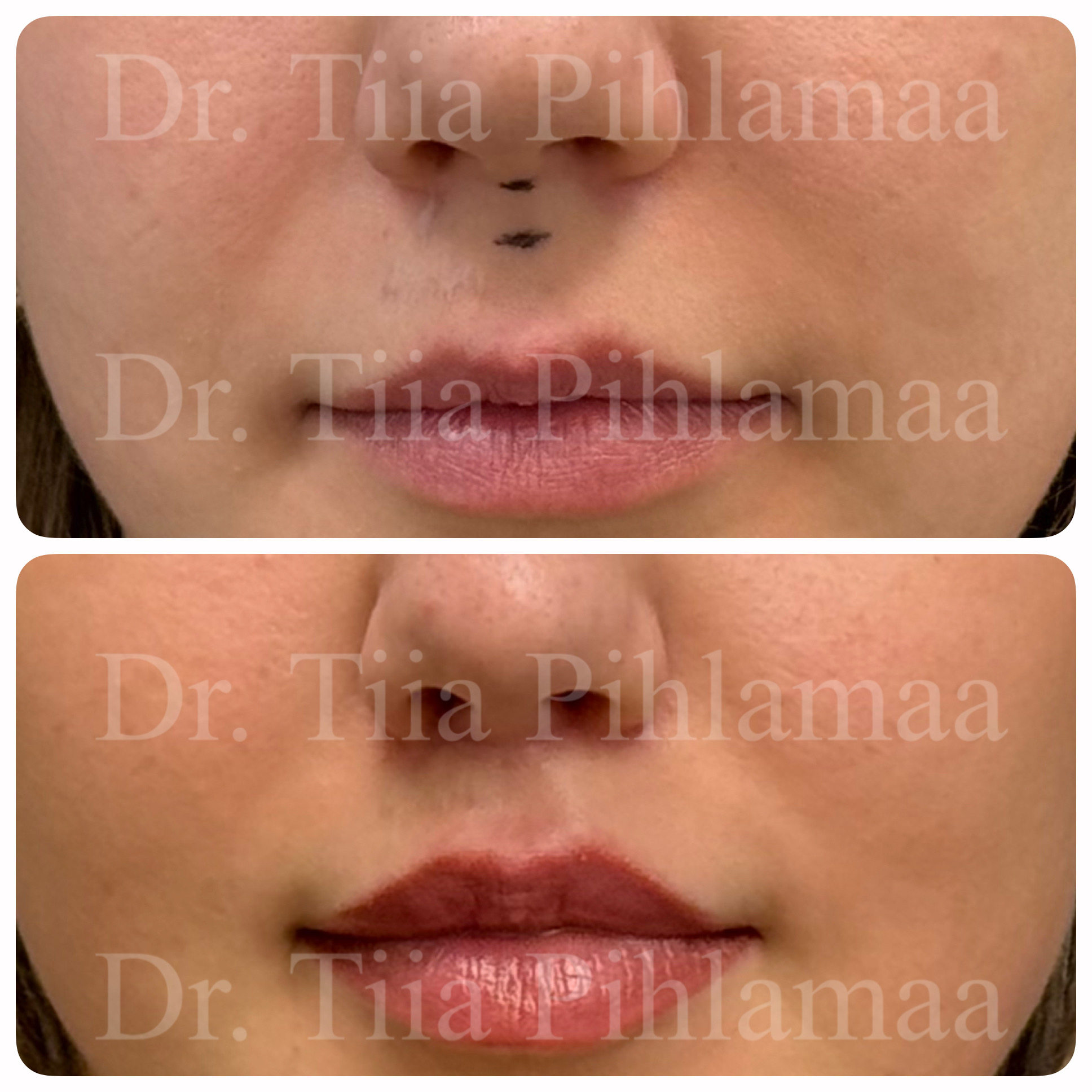 Before and after photographs of a procedure on the lip area combined in a single image; the upper photo shows the appearance before the procedure and the lower one after it. The patient has given consent for publication.