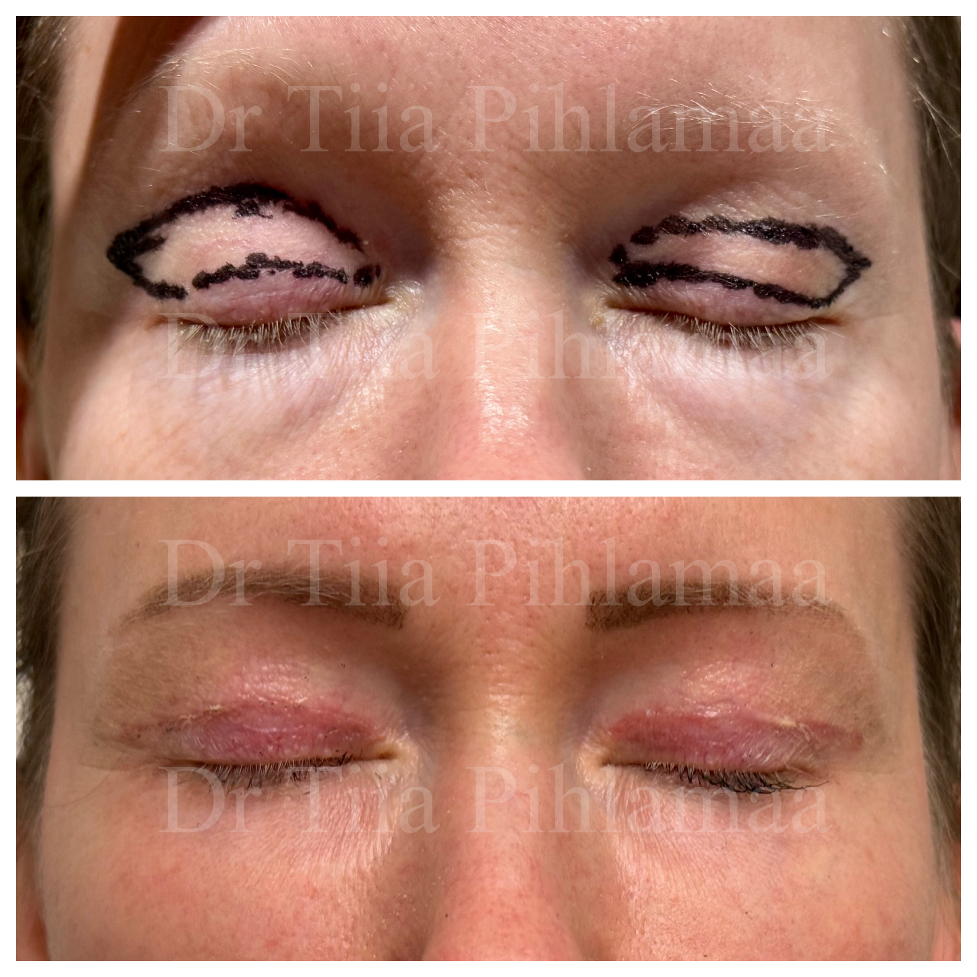 Closed-eye before and after photographs of upper and lower eyelid treatment; before surgery above and six weeks after surgery below. The patient has given consent for publication.