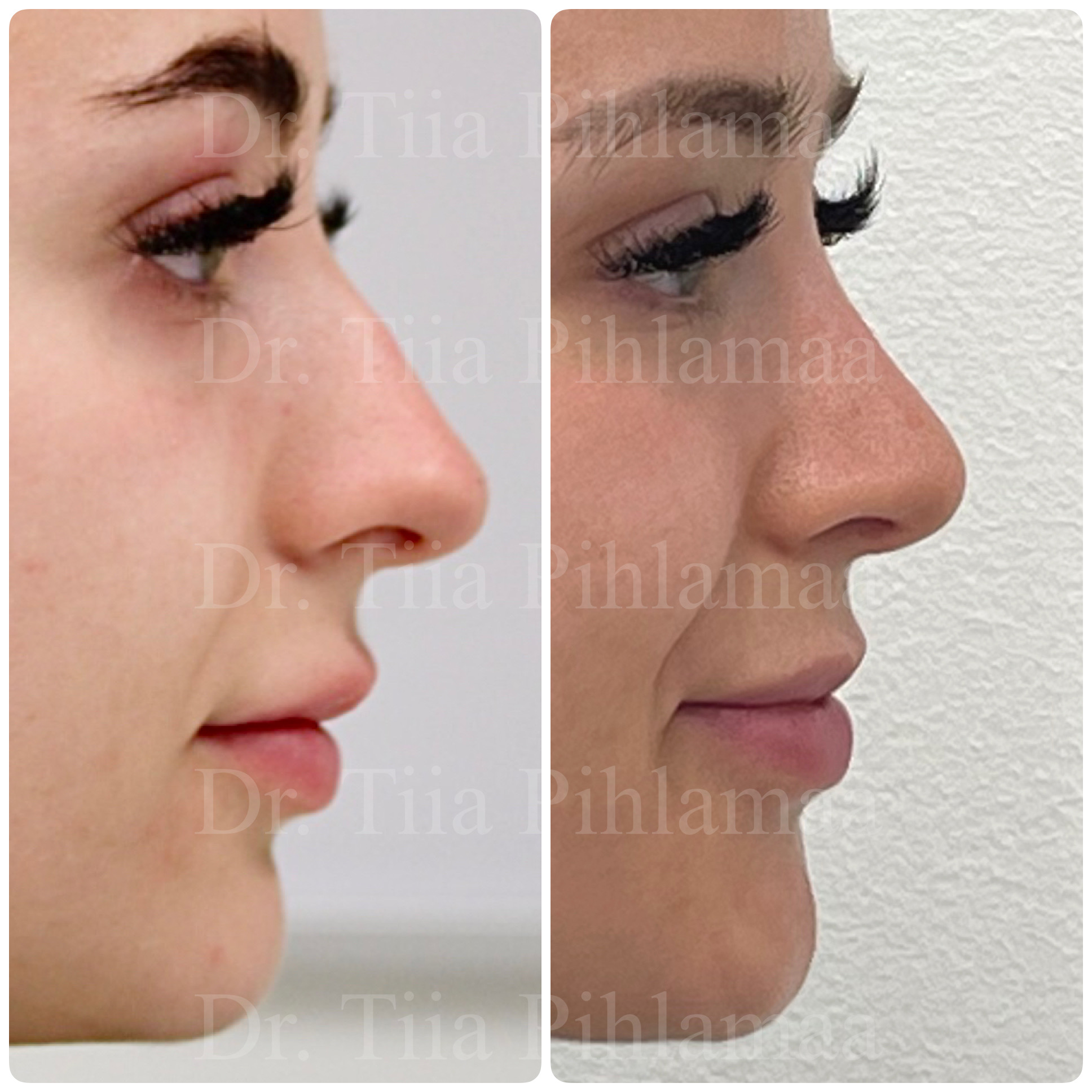 Before and after photographs of a nasal procedure in side profile combined in a single image; the left photo shows the appearance before the procedure and the right one after it. The patient has given consent for publication.