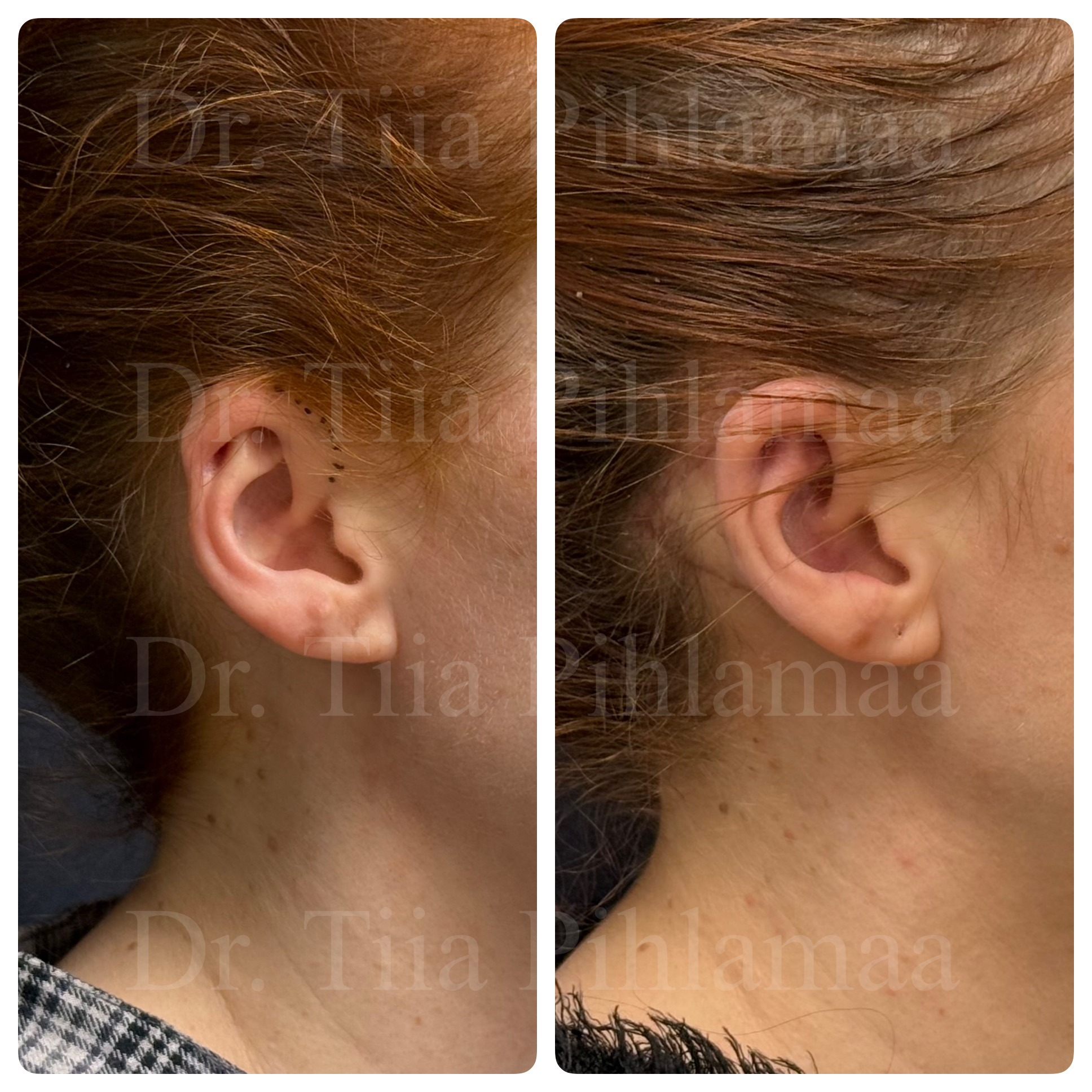 Before and after photographs of cryptotia correction surgery in side profile; surgical markings are visible in the before photo. The left photo shows the appearance before the procedure and the right one two months after it. The patient has given consent for publication.