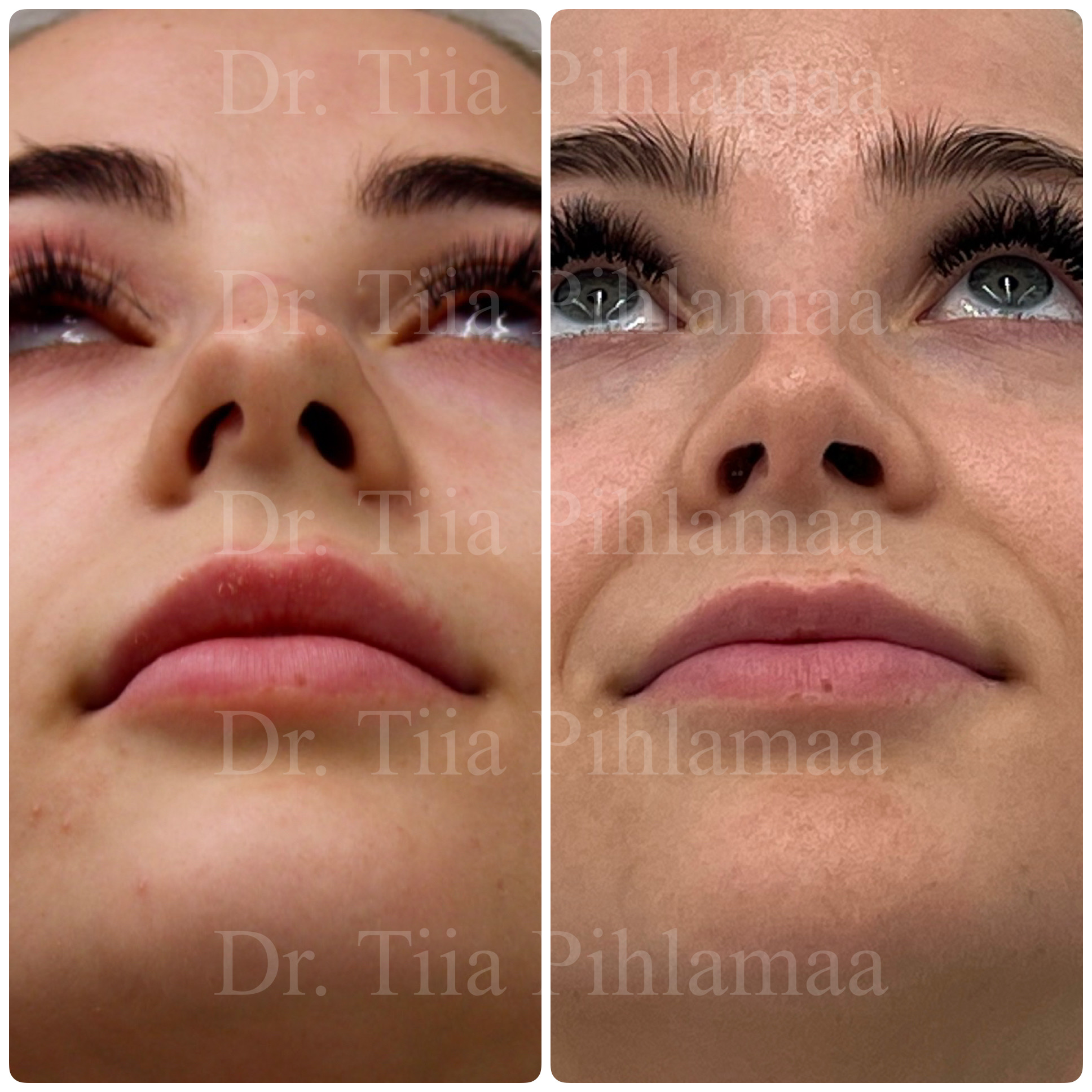 Before and after close-up photographs of a nasal procedure from below looking upward combined in a single image; the left photo shows the appearance before the procedure and the right one after it. The patient has given consent for publication.