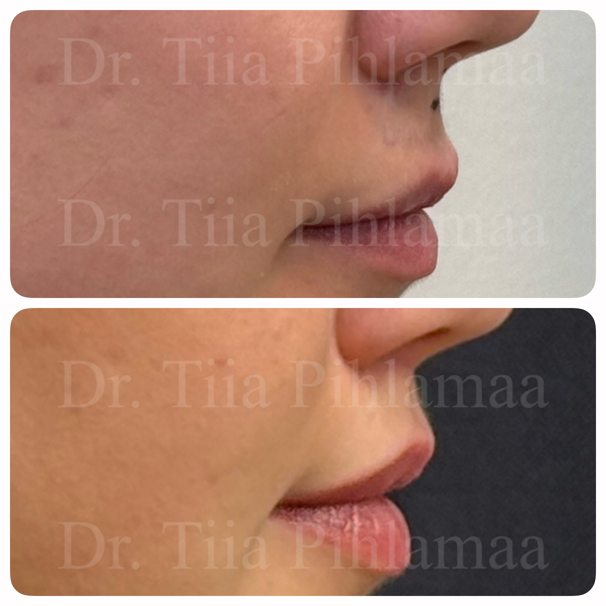 Before and after photographs of a procedure on the lip area in side profile combined in a single image; the upper photo shows the appearance before the procedure and the lower one after it. The patient has given consent for publication.