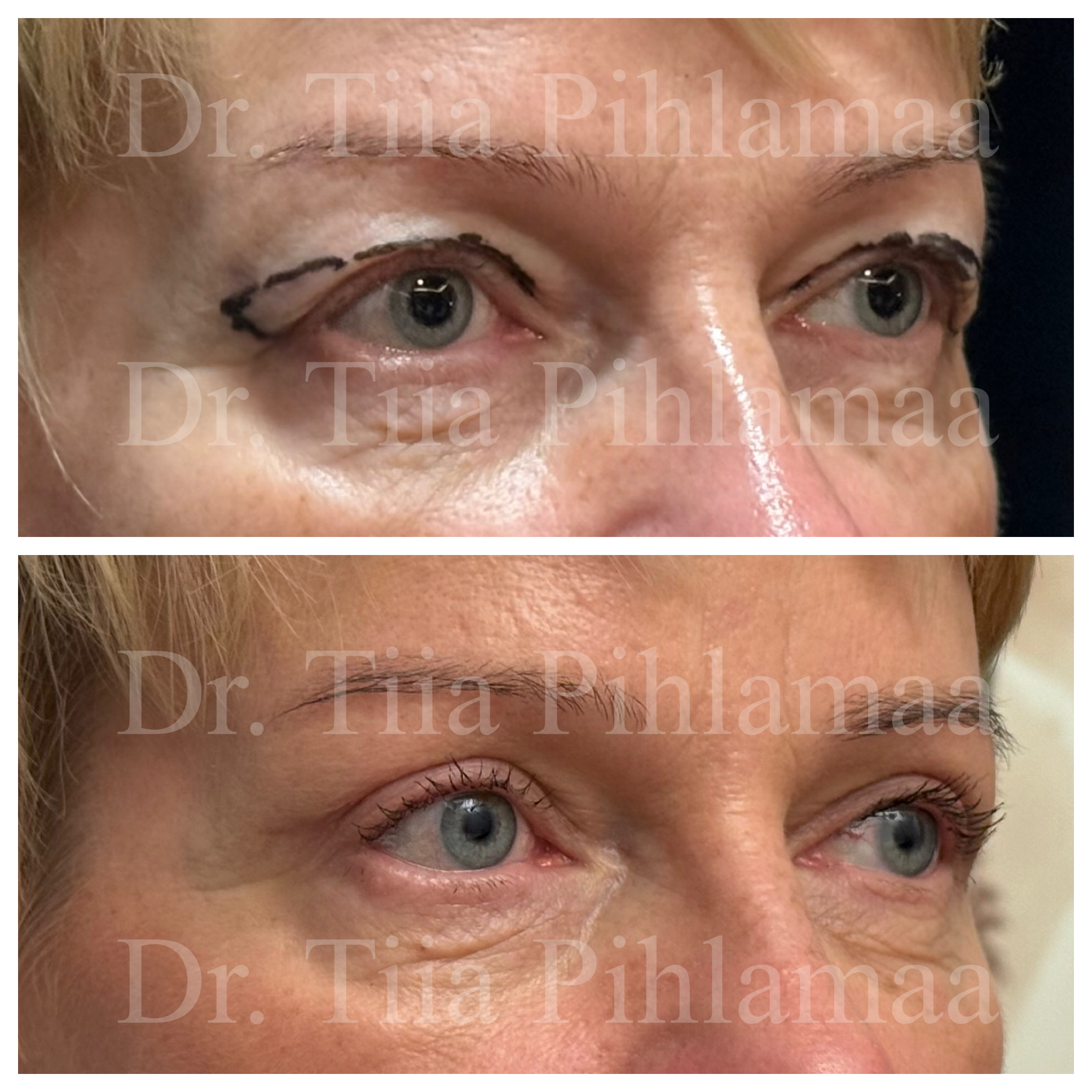 Before and after photographs of upper eyelid surgery with open eyes, stacked vertically; surgical markings are visible in the before photo. The patient has given consent for publication.
