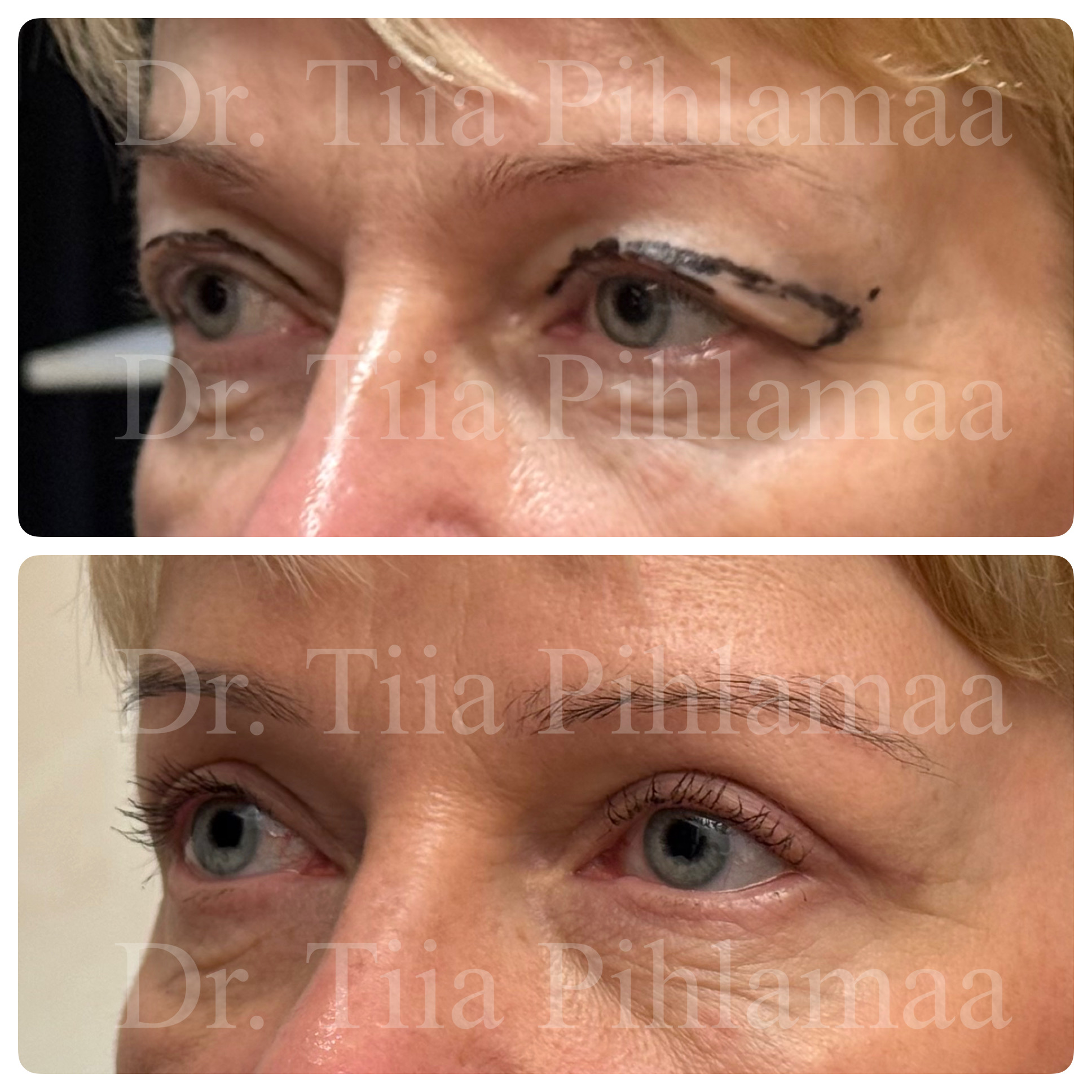 Before and after photographs of upper eyelid surgery in a three-quarter view, stacked vertically; surgical markings are visible in the before photo. The patient has given consent for publication.