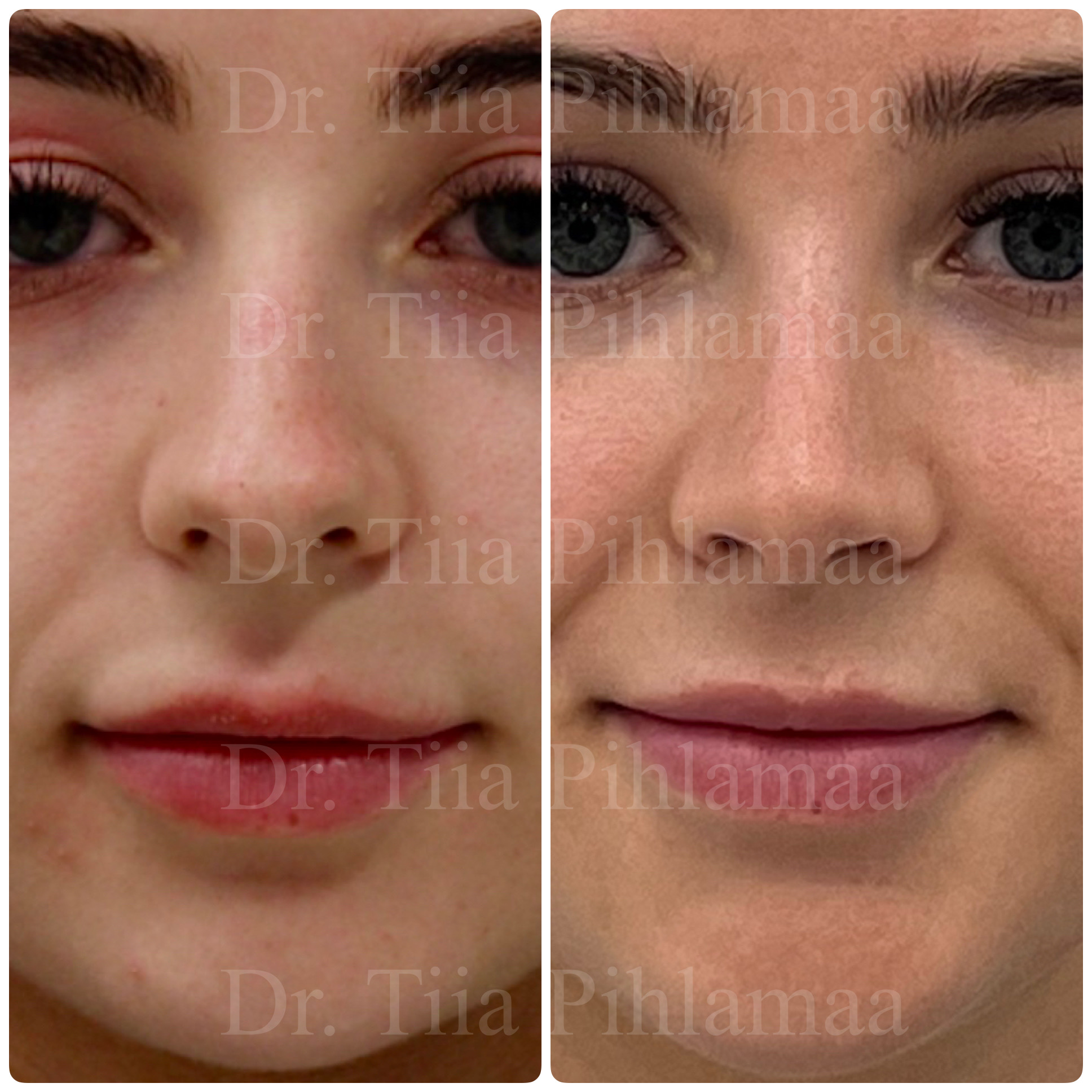 Before and after photographs of a nasal procedure from the front combined in a single image; the left photo shows the appearance before the procedure and the right one after it. The patient has given consent for publication.