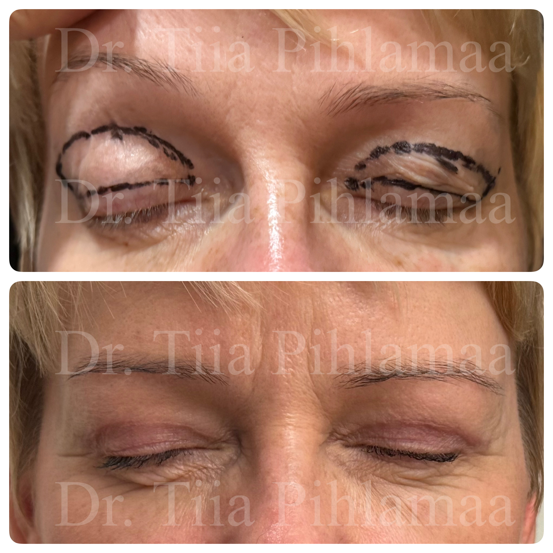 Before and after photographs of upper eyelid surgery with closed eyes, stacked vertically; surgical markings are visible in the before photo. The patient has given consent for publication.