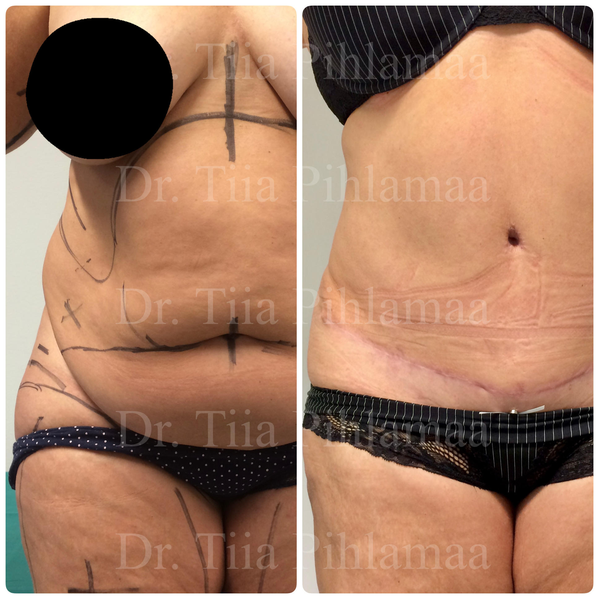 Before and after photographs of abdominal surgery combined in a single image; the left photo shows the appearance before the procedure and the right one after it. The patient has given consent for publication.