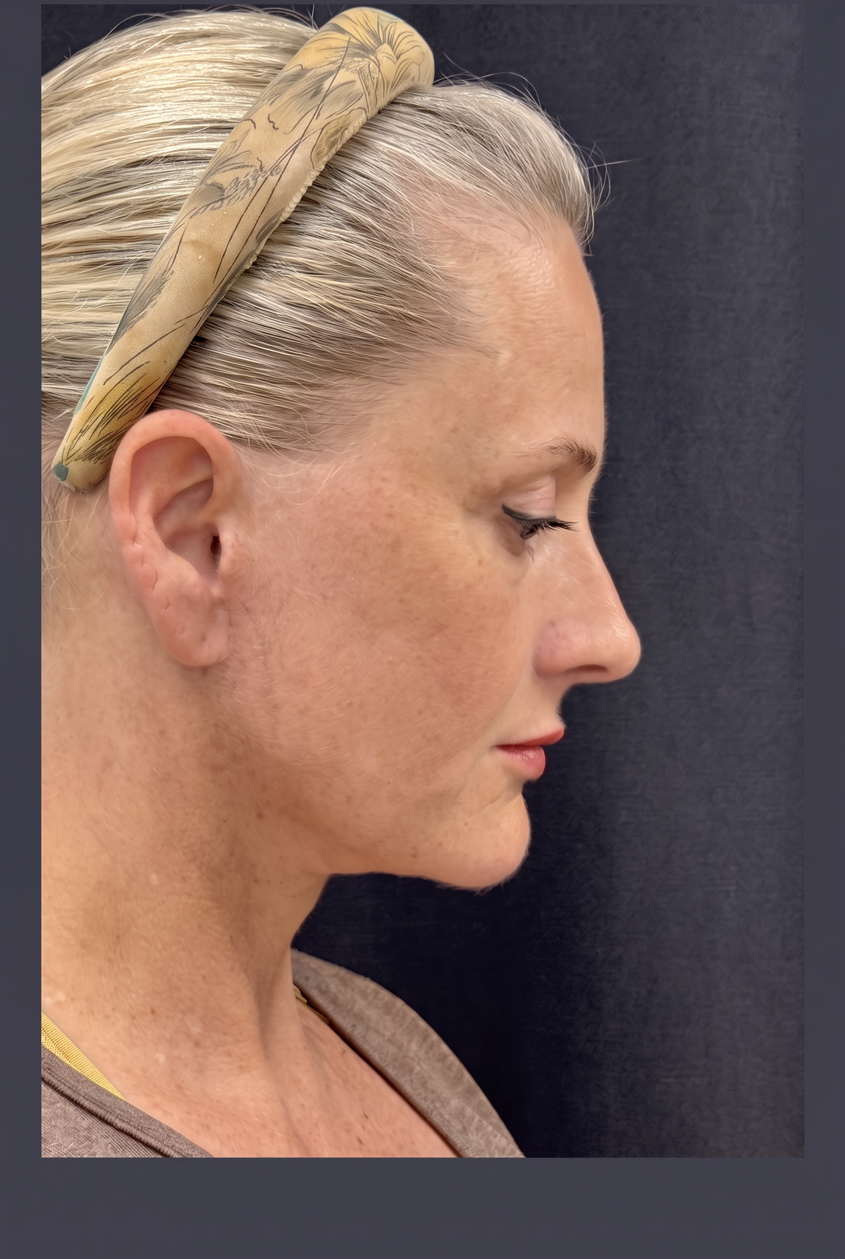 The same patient's facial side profile after surgery, showing the hairline, ear and neck